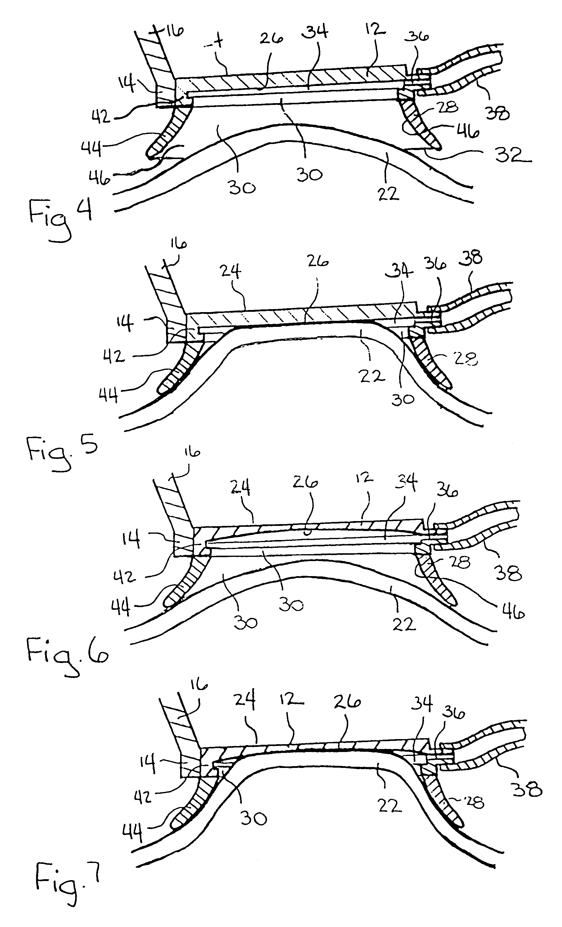 Device and method for reducing corneal induced aberrations during ophthalmic laser surgery
