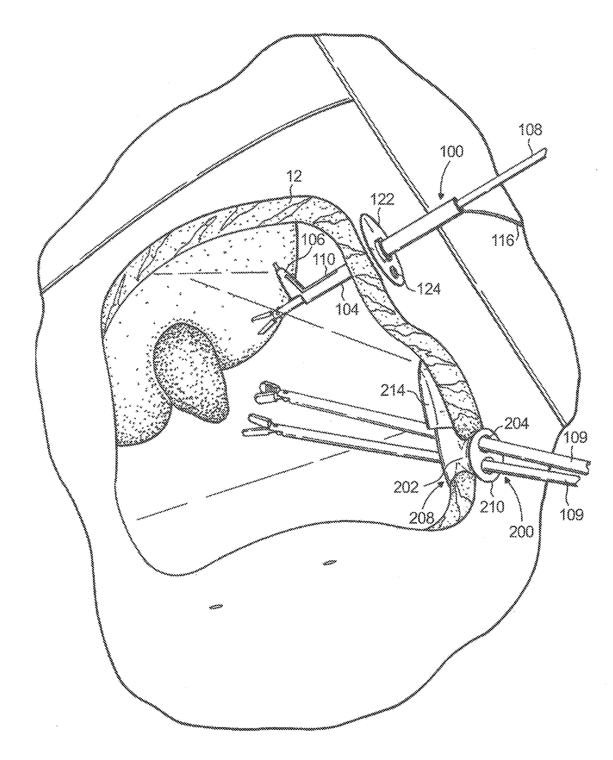 An access device having modular inserts and supporting accessories used in minimally invasive surgical procedures