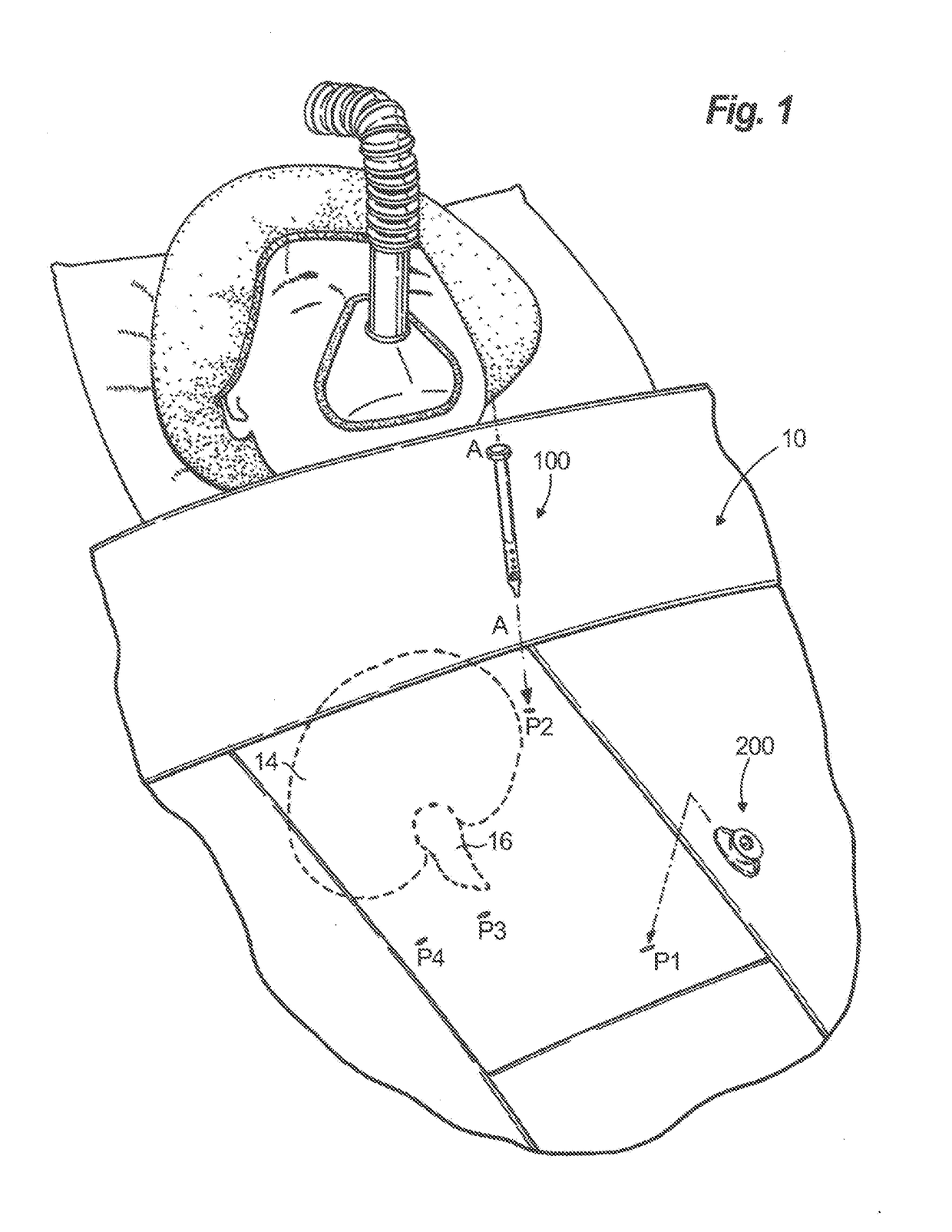 An access device having modular inserts and supporting accessories used in minimally invasive surgical procedures