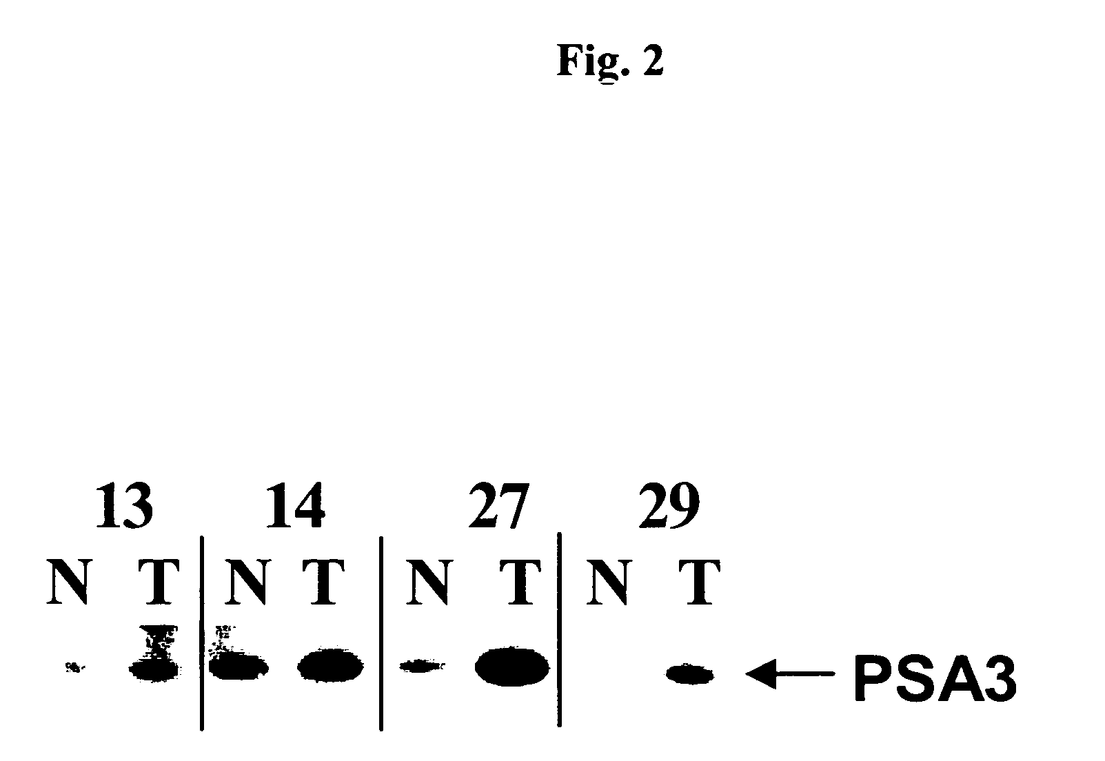 Use of protein PSA3 as a marker for colorectal cancer