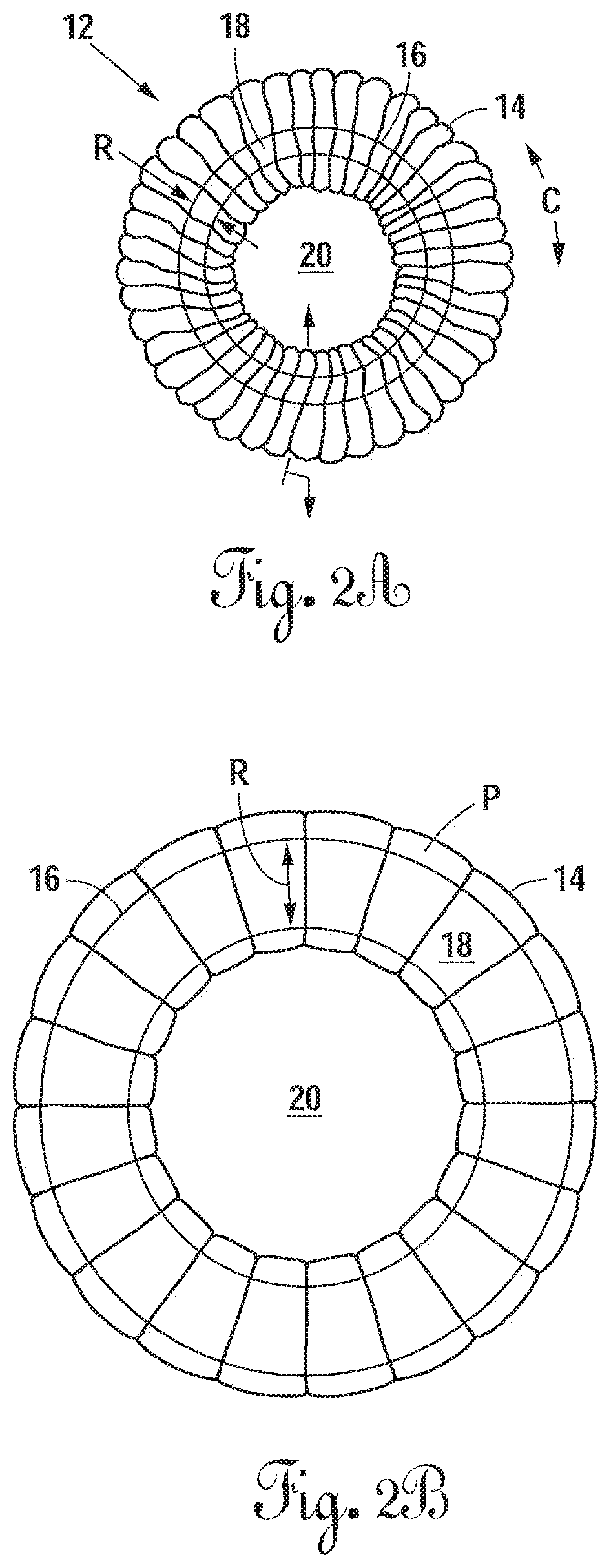 Radially expandable annulus reinforcement prosthesis