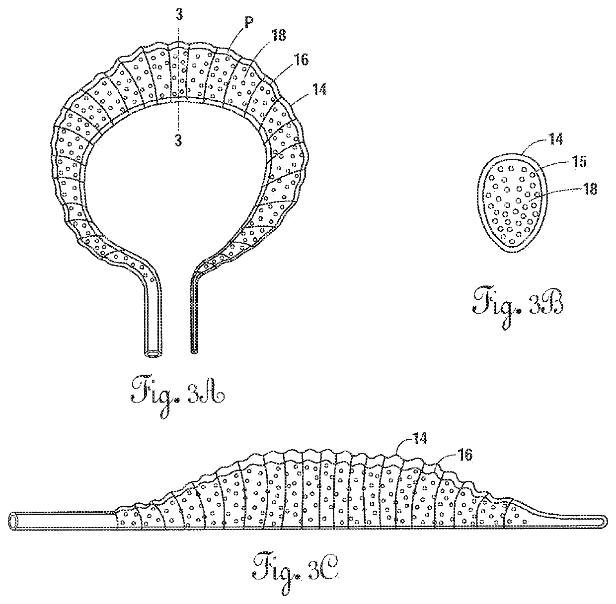 Radially expandable annulus reinforcement prosthesis