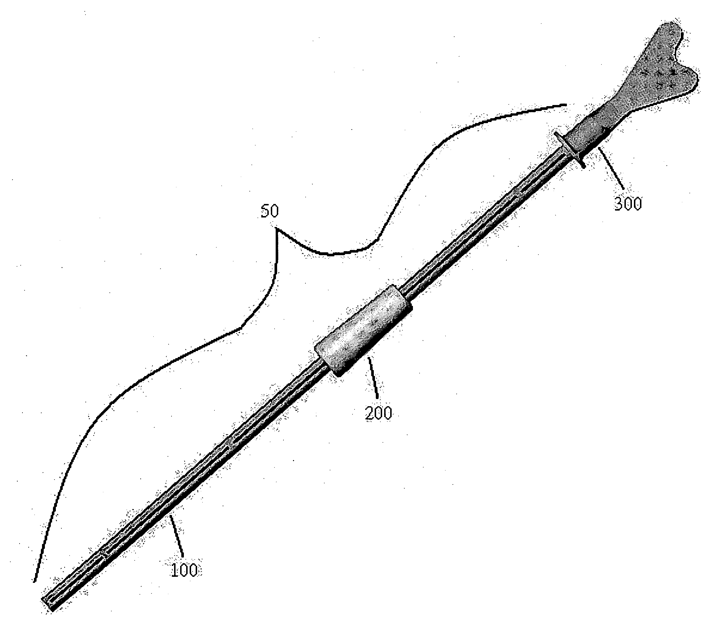 Pap smear collection device with ejection sleeve