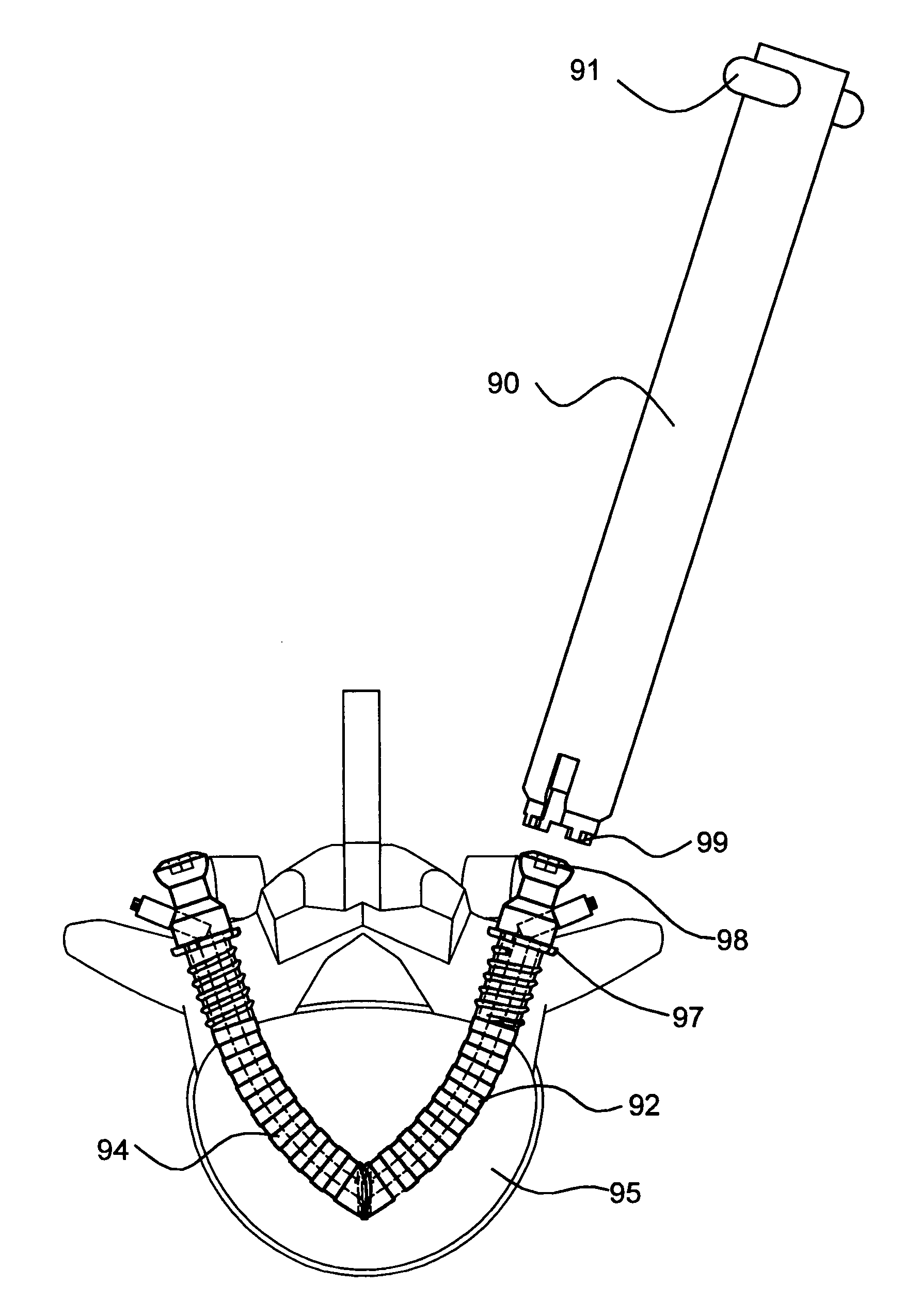 Bone anchoring system