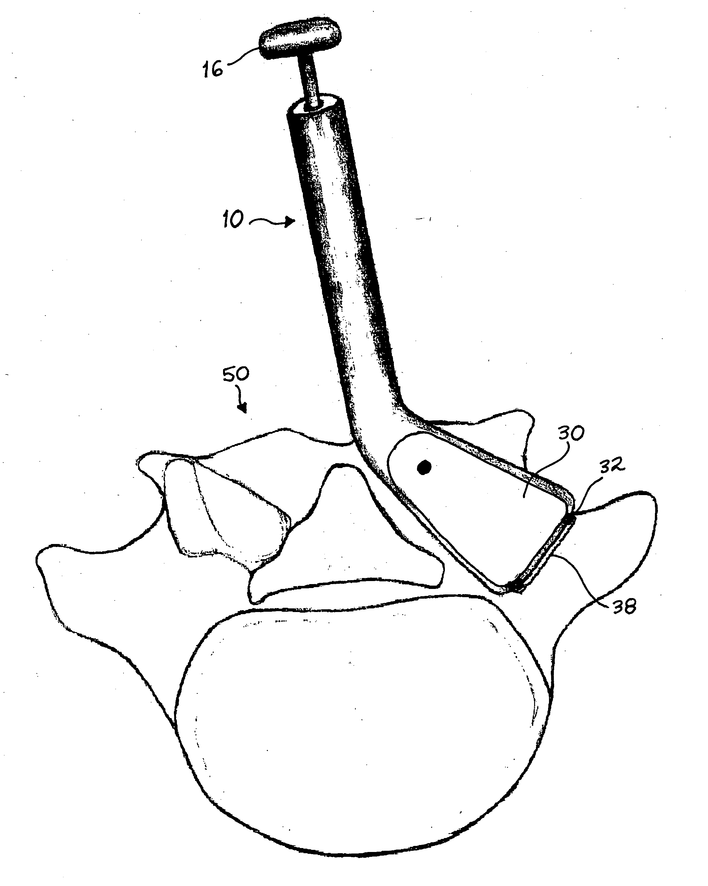 Devices for performing fusion surgery using a split thickness technique to provide vascularized autograft