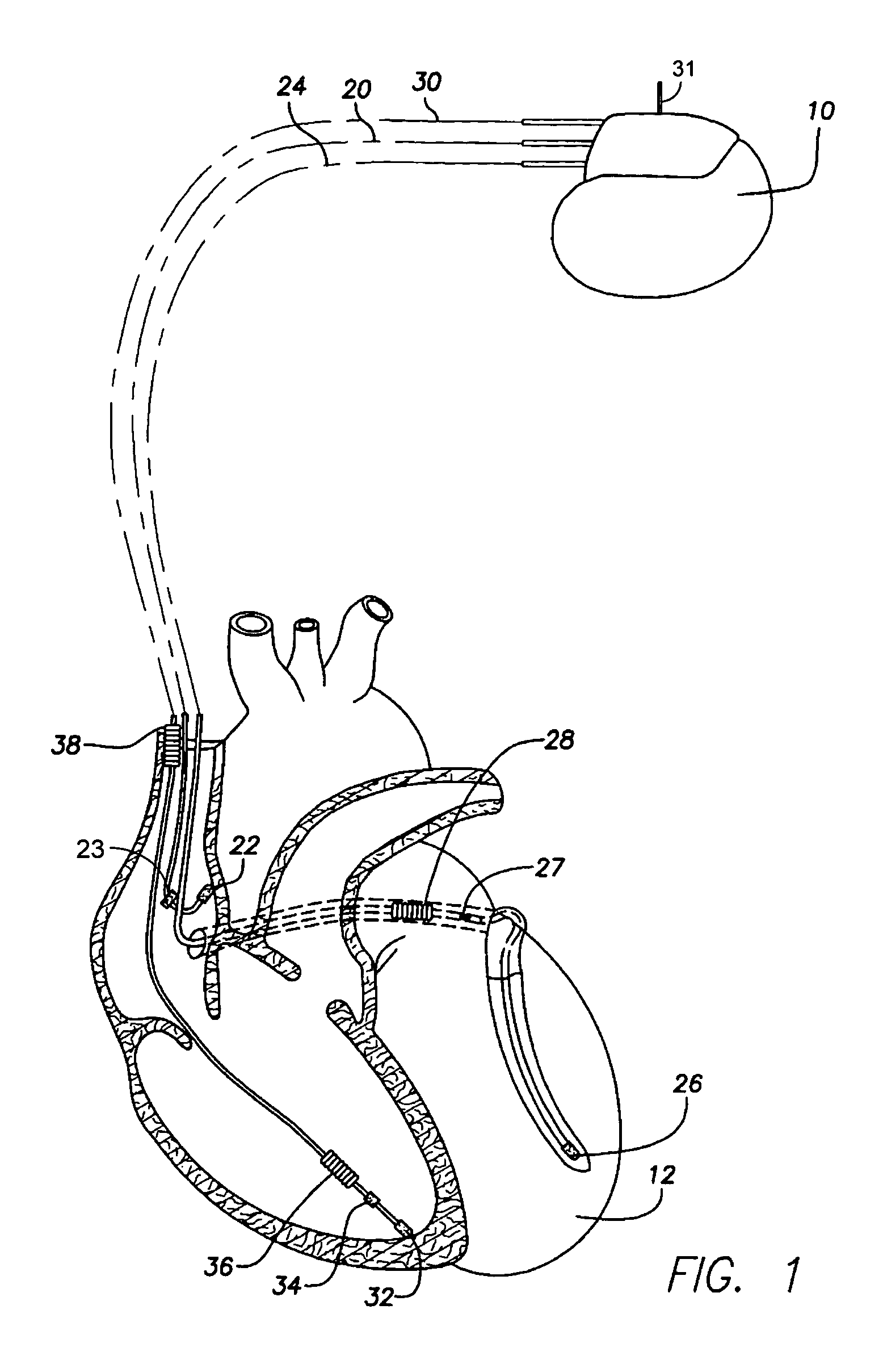 System and method for detecting cardiac ischemia using an implantable medical device