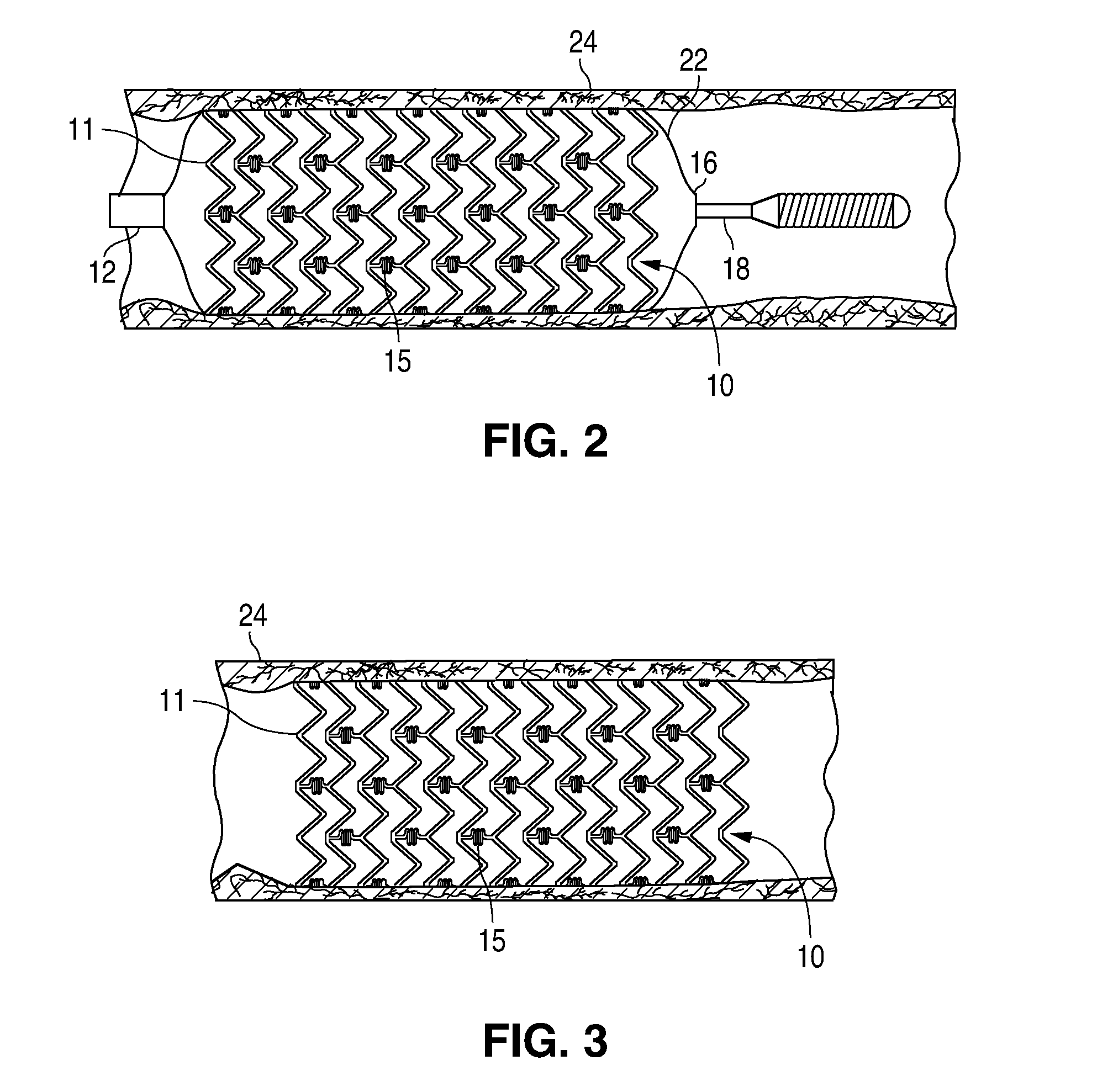 Treatment Of Diabetic Patients With A Stent And An Adjunctive Drug Formulation