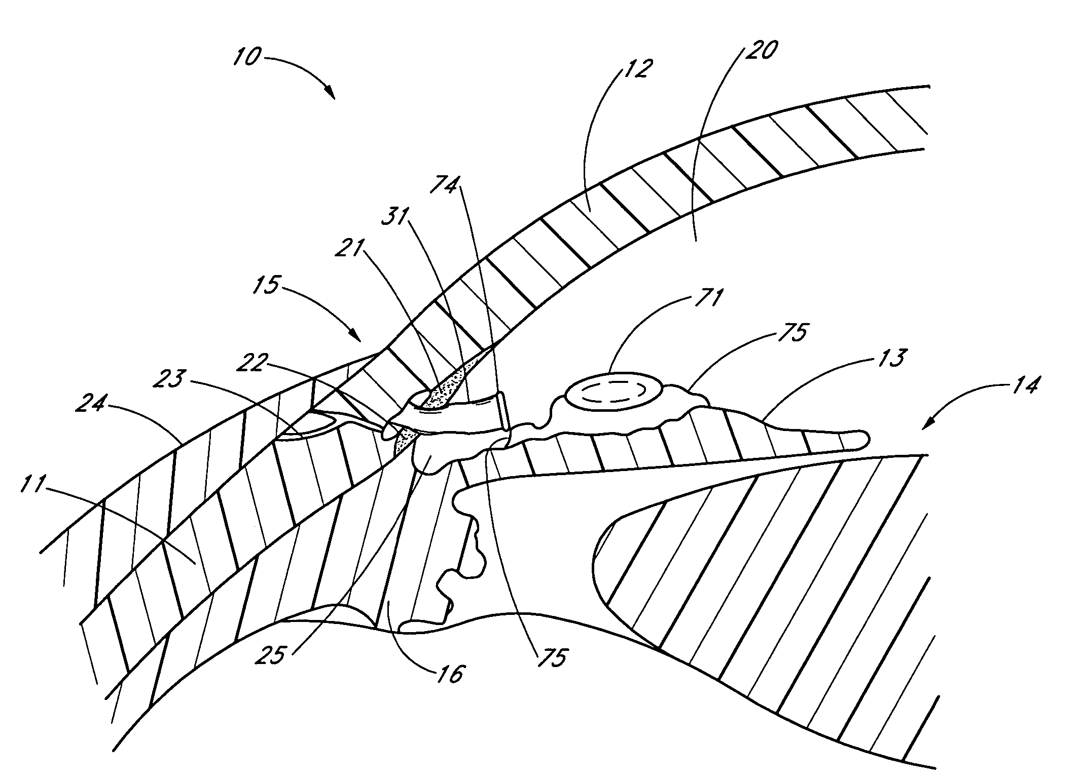 Implant with intraocular pressure sensor for glaucoma treatment