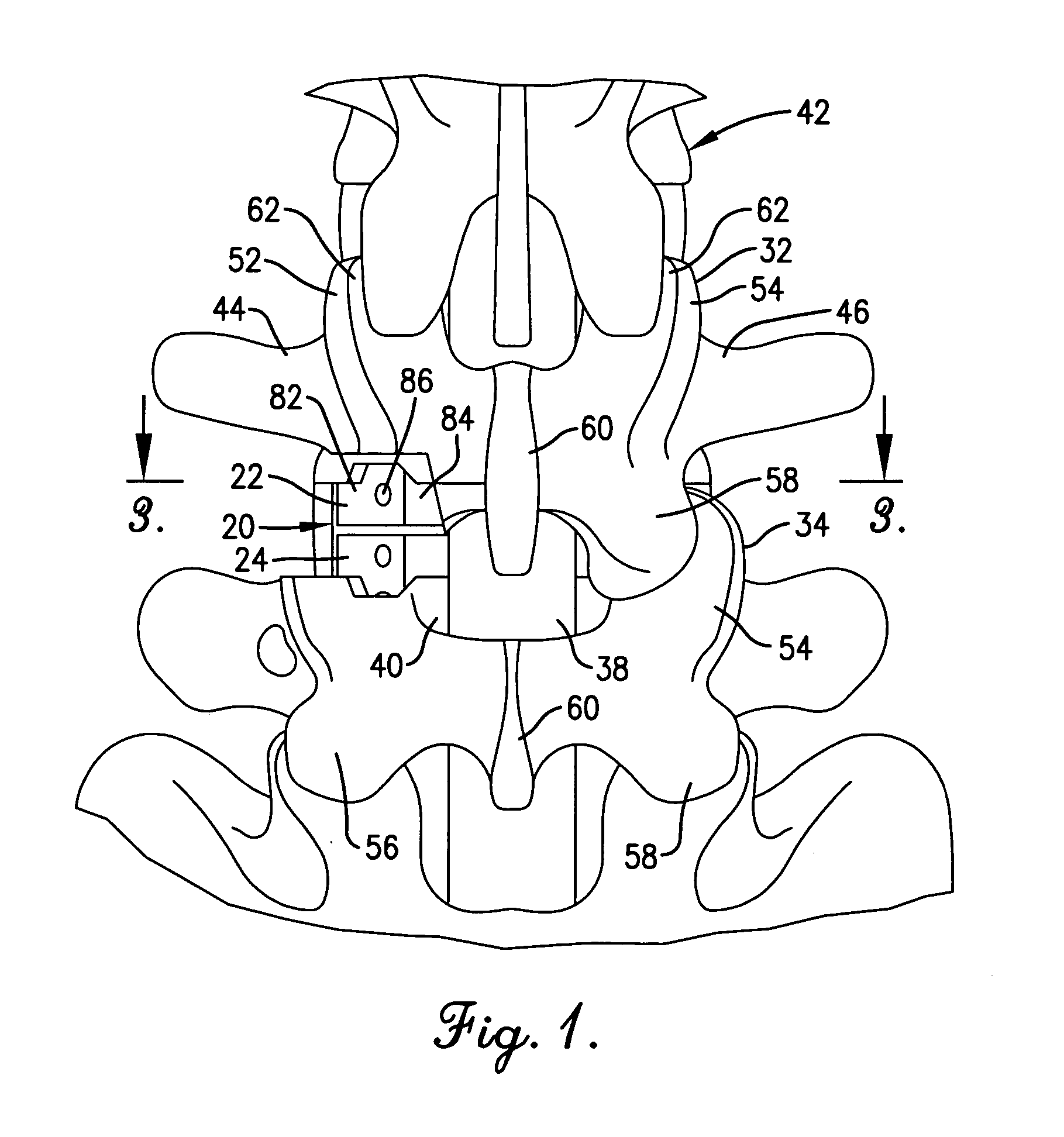Artificial spinal disc, insertion tool, and method of insertion
