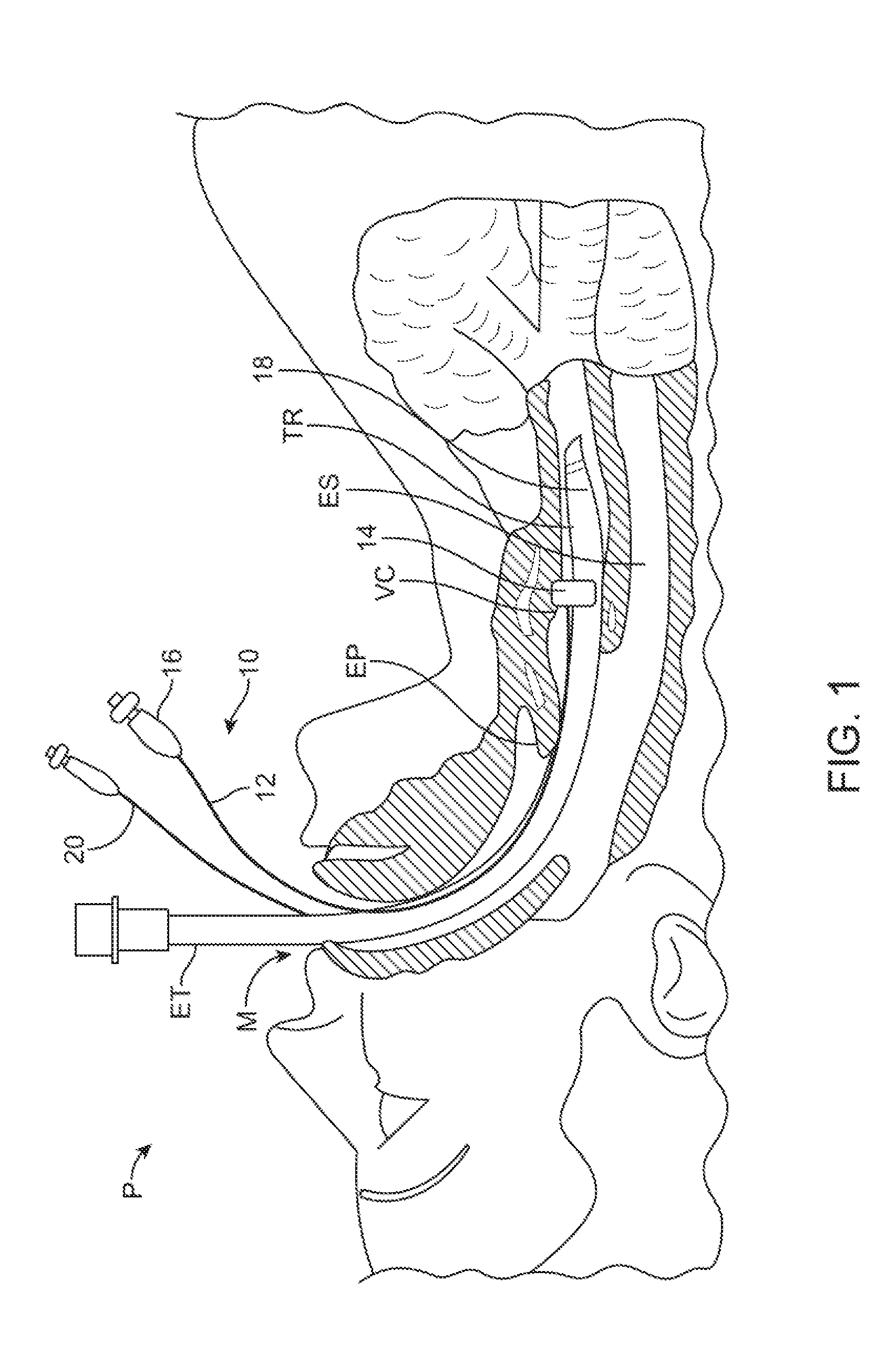 Devices and methods for preventing tracheal aspiration