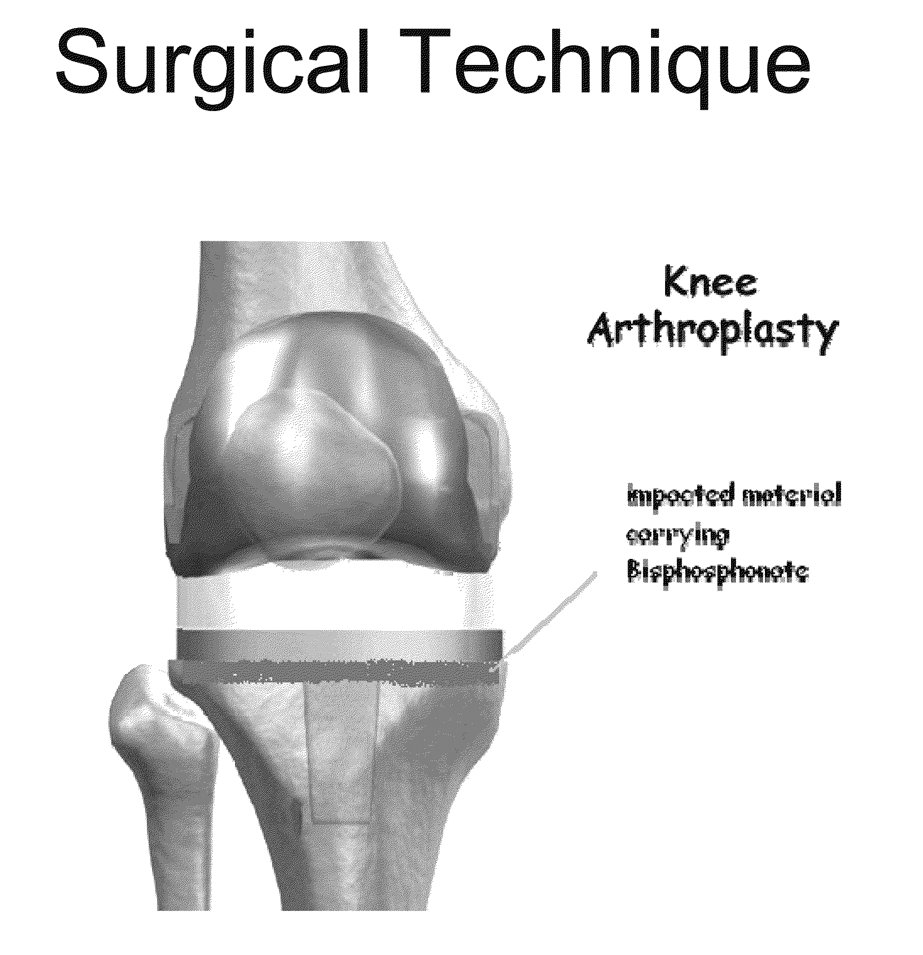 Method of delivering a biphosphonate and/or strontium ranelate below the surface of a bone