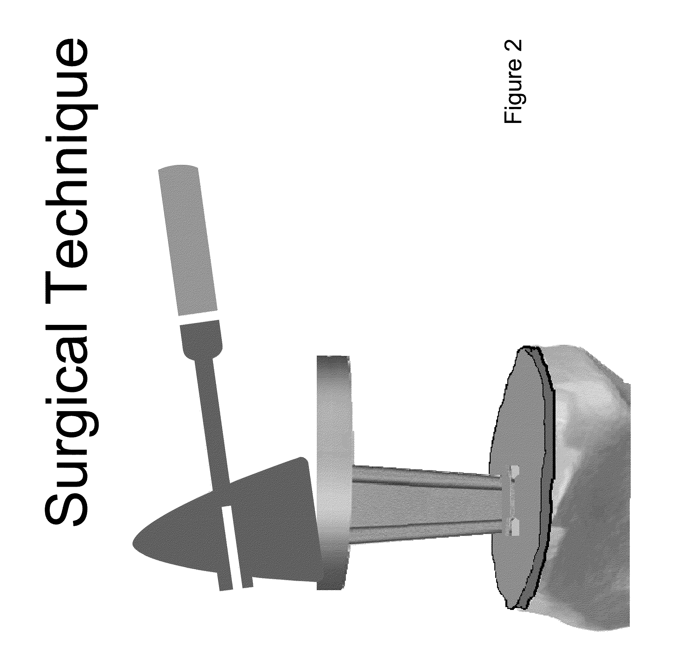Method of delivering a biphosphonate and/or strontium ranelate below the surface of a bone