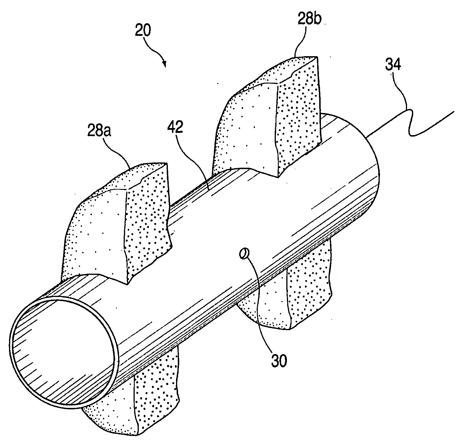 Catheter-based septal occlusion device and adhesive delivery system