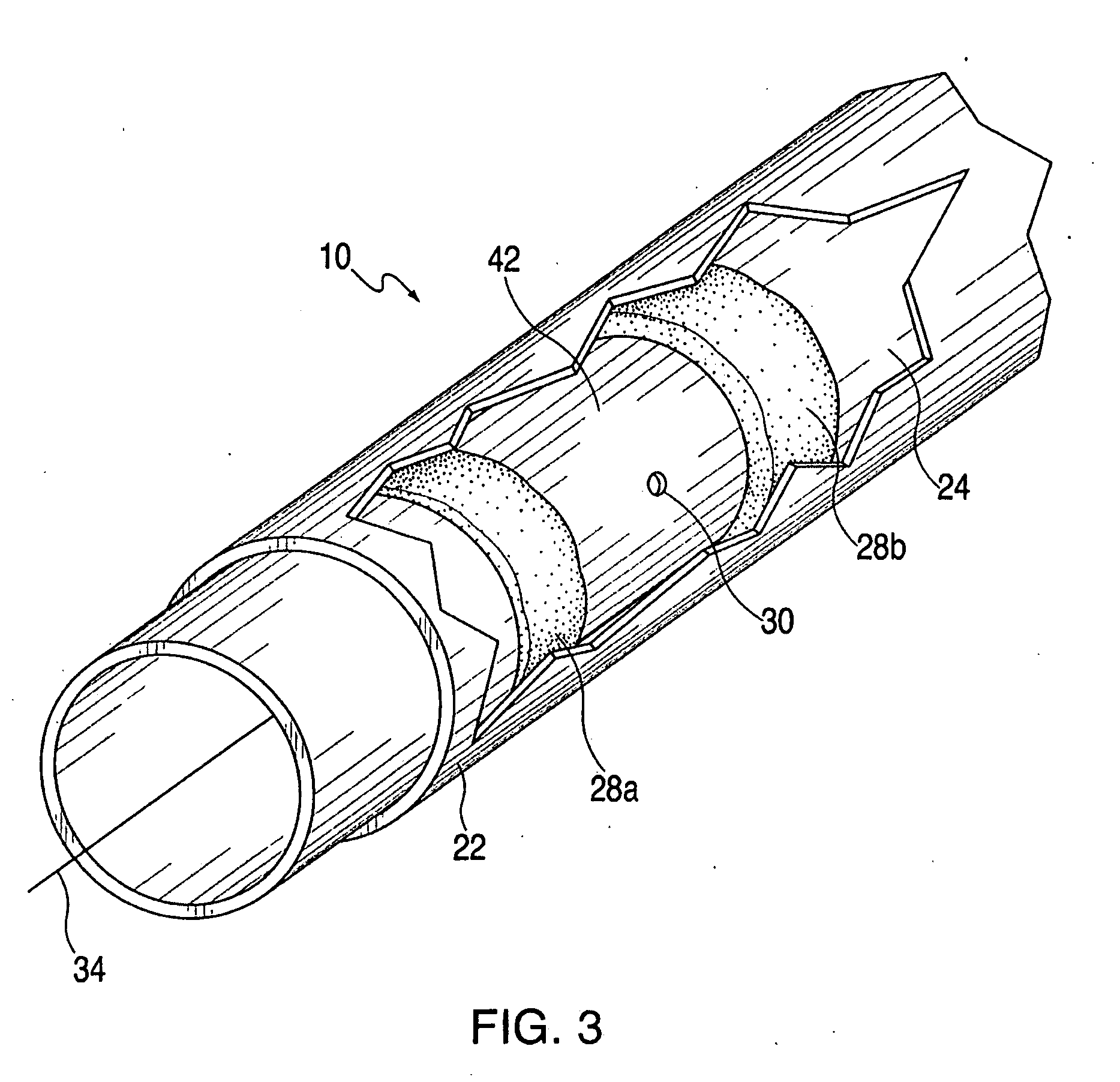 Catheter-based septal occlusion device and adhesive delivery system