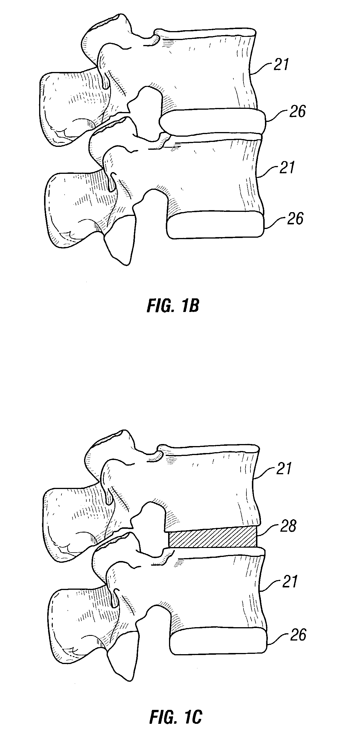Bone compression devices and systems and methods of contouring and using same