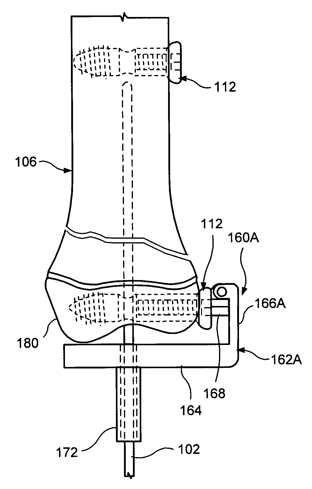 System for intramedullary rod fixation and method therefor