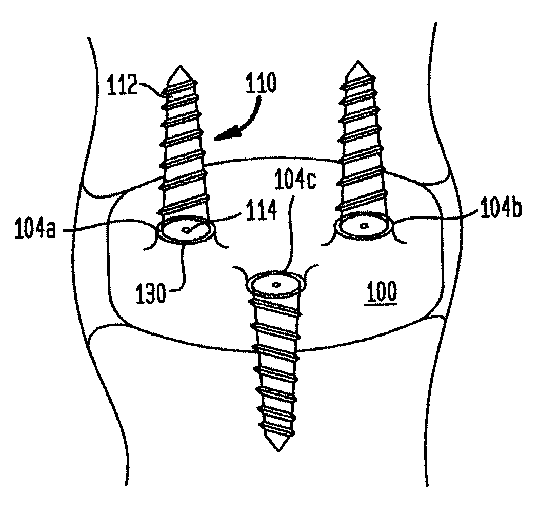 Porous interbody fusion device having integrated polyaxial locking interference screws