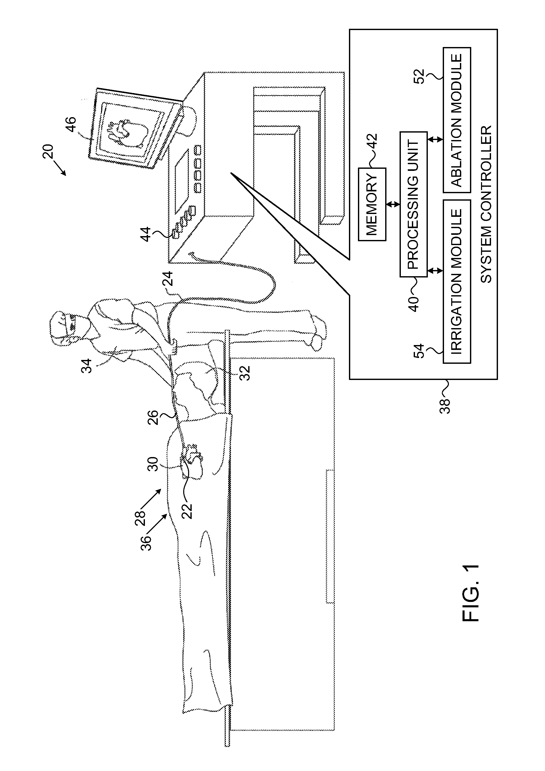 Catheter with spray irrigation