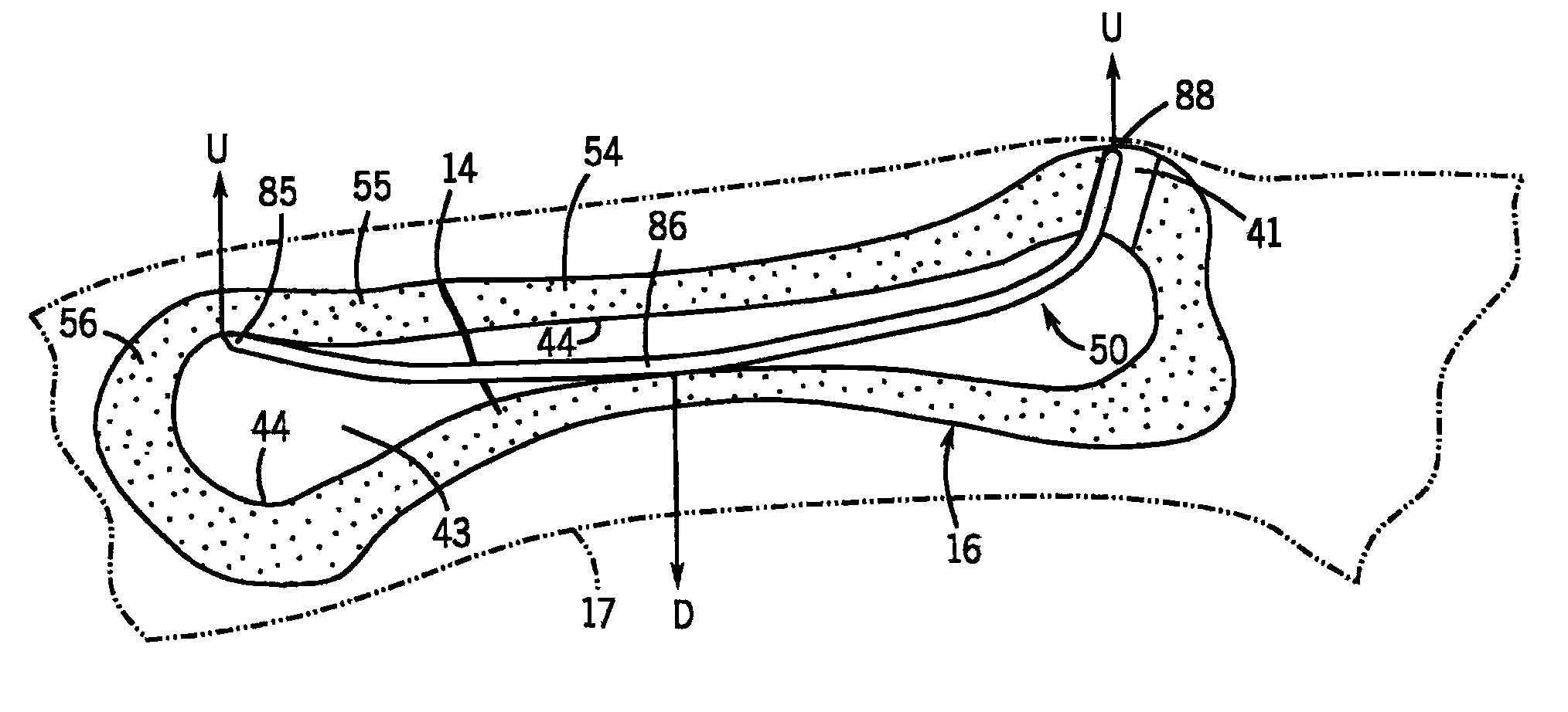 Intramedullary fixation device for small bone fractures