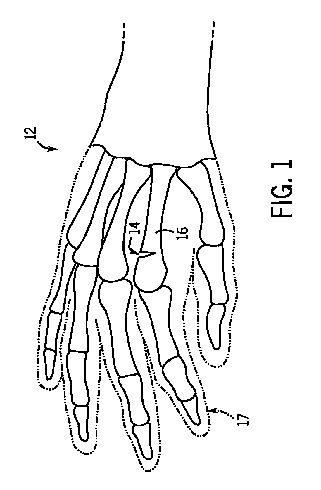 Intramedullary fixation device for small bone fractures