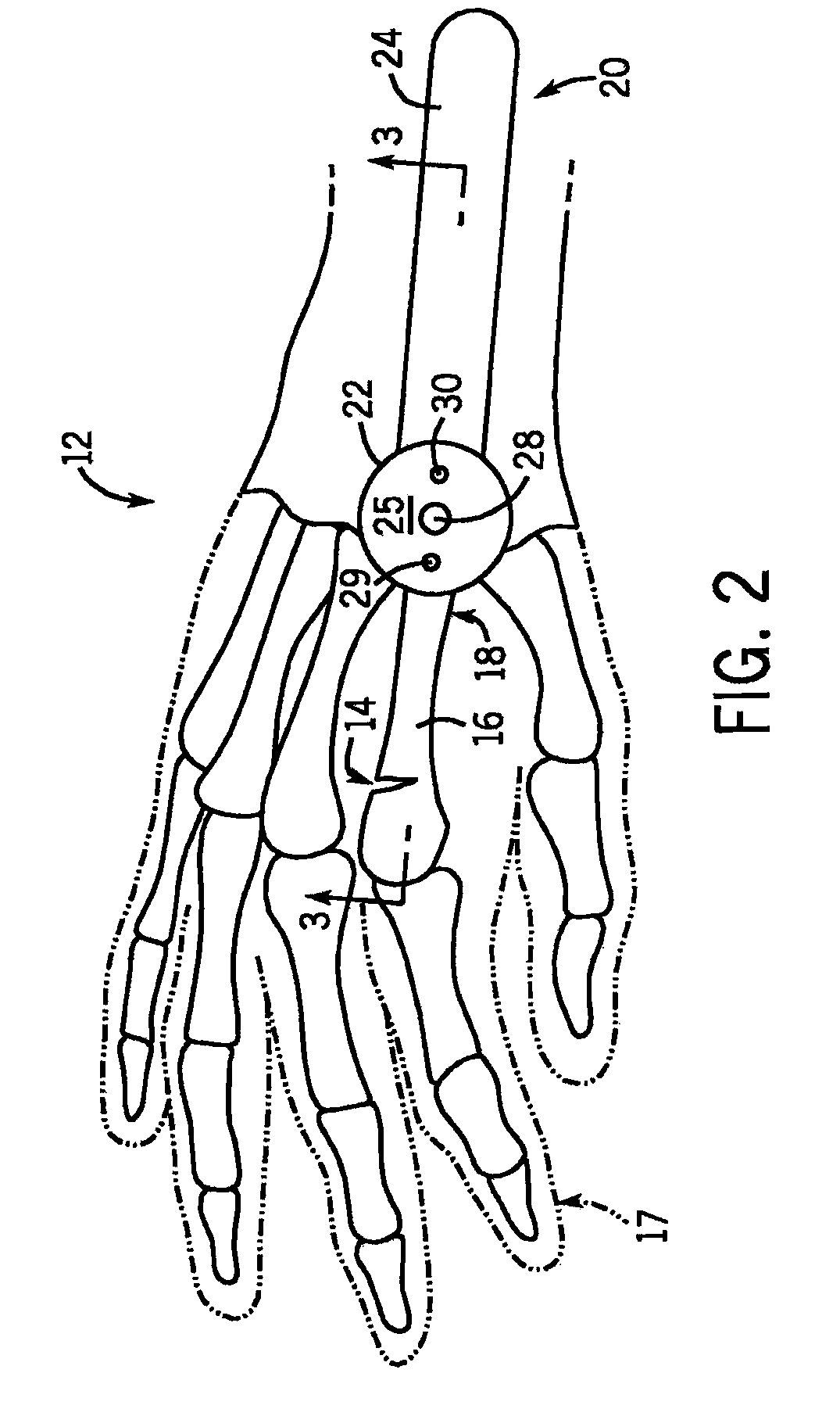 Intramedullary fixation device for small bone fractures