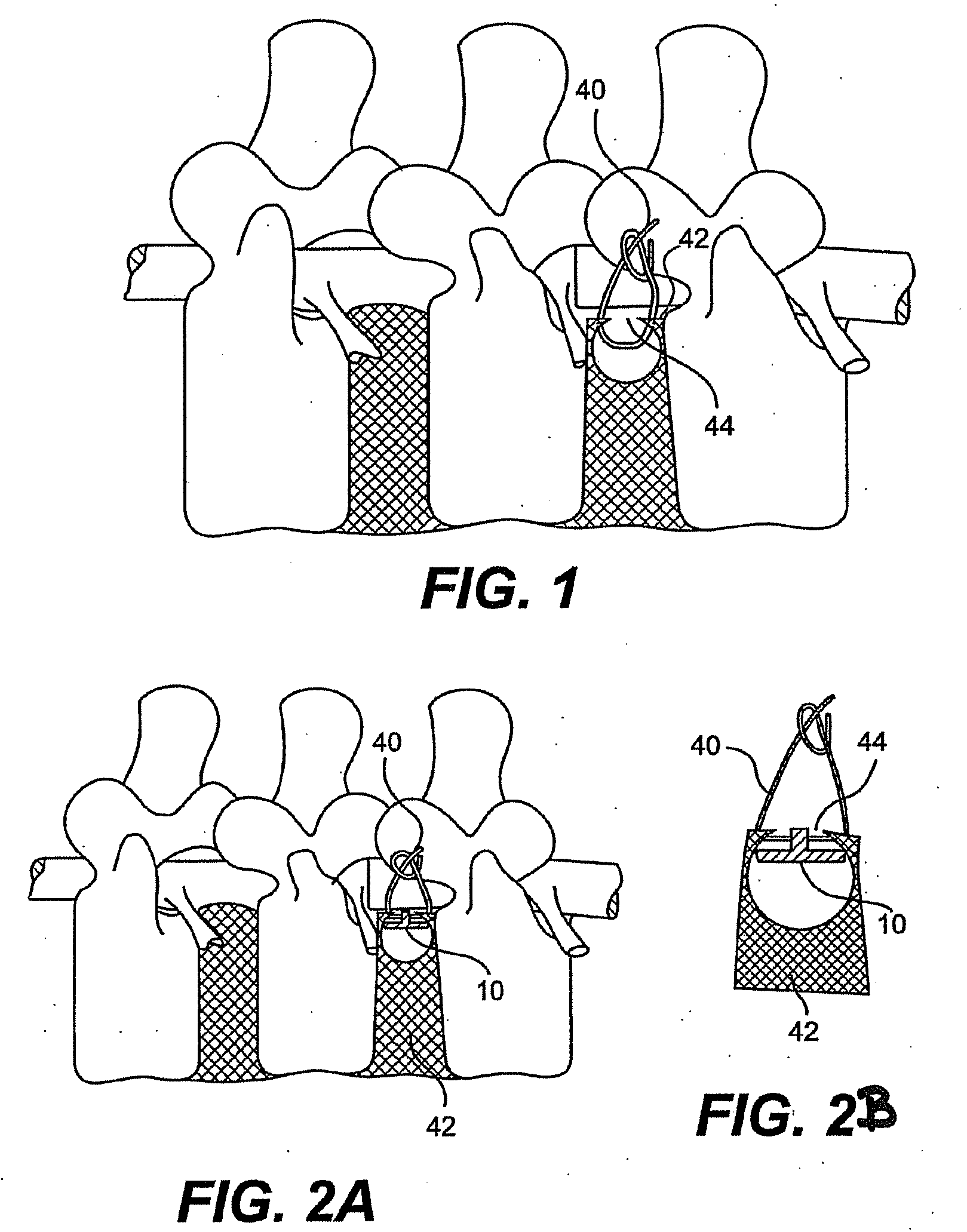 Method and apparatus for the treatment of the intervertebral disc annulus