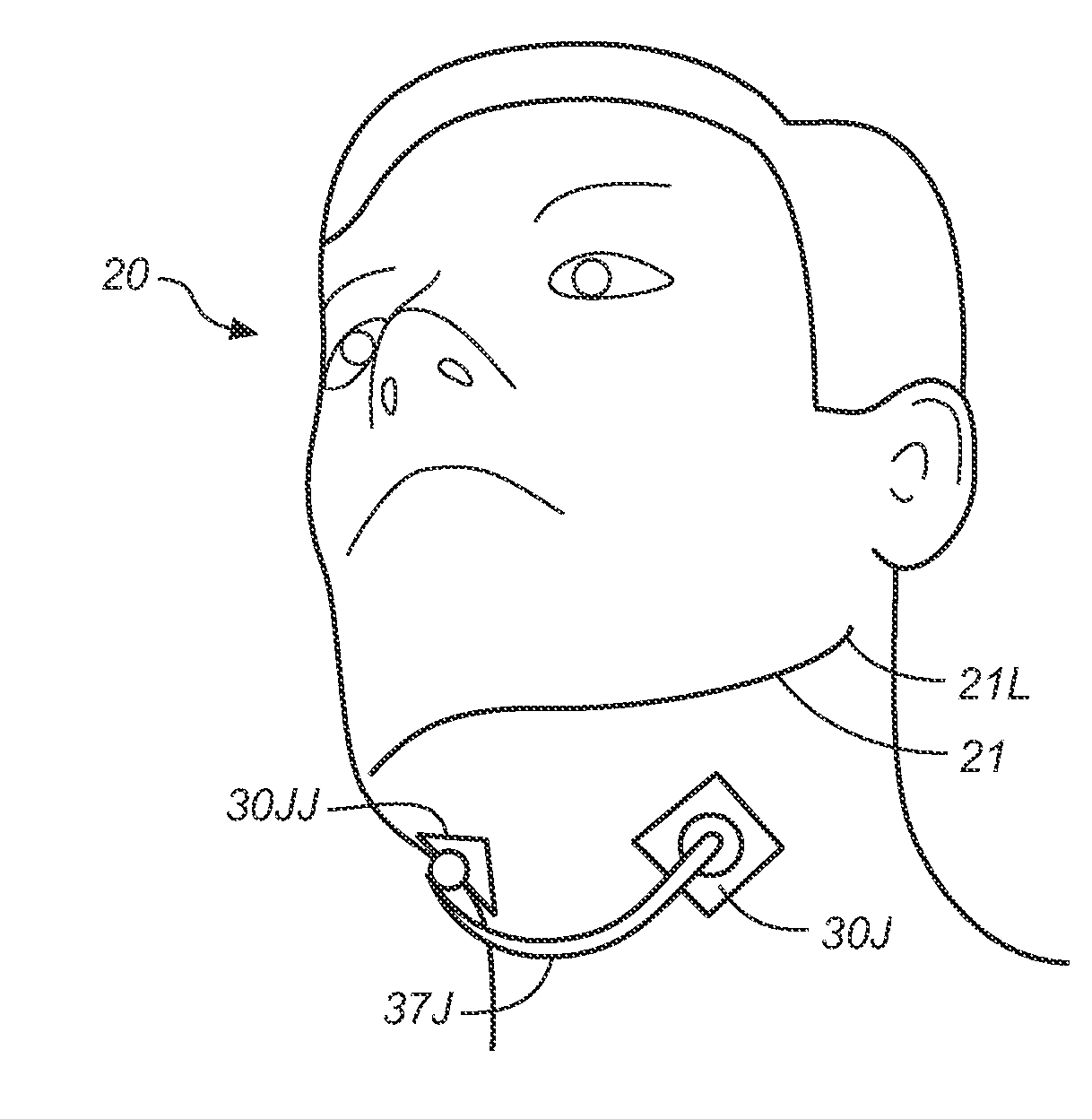 Method and apparatus for treatment of snoring and sleep apnea