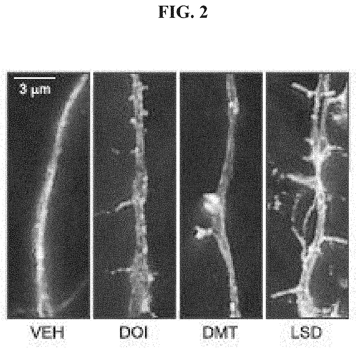 Method of Inducing Dendritic and Synaptic Genesis in Neurodegenerative Chronic Diseases
