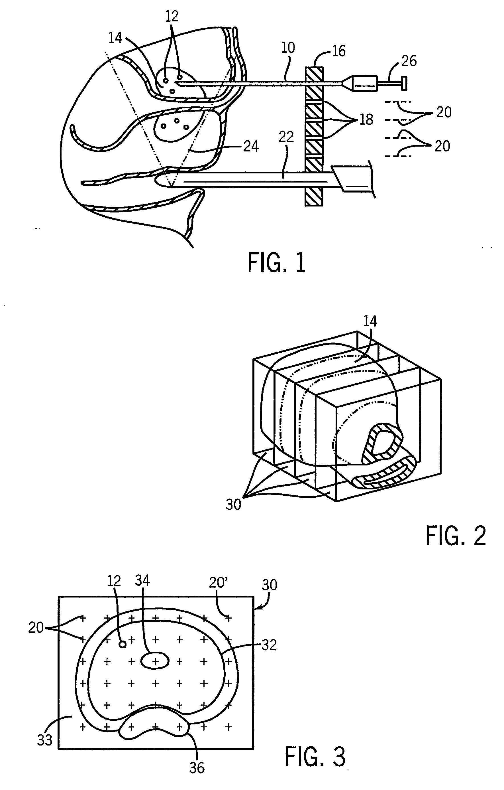 Method and apparatus for treatment planning using implanted radioactive sources