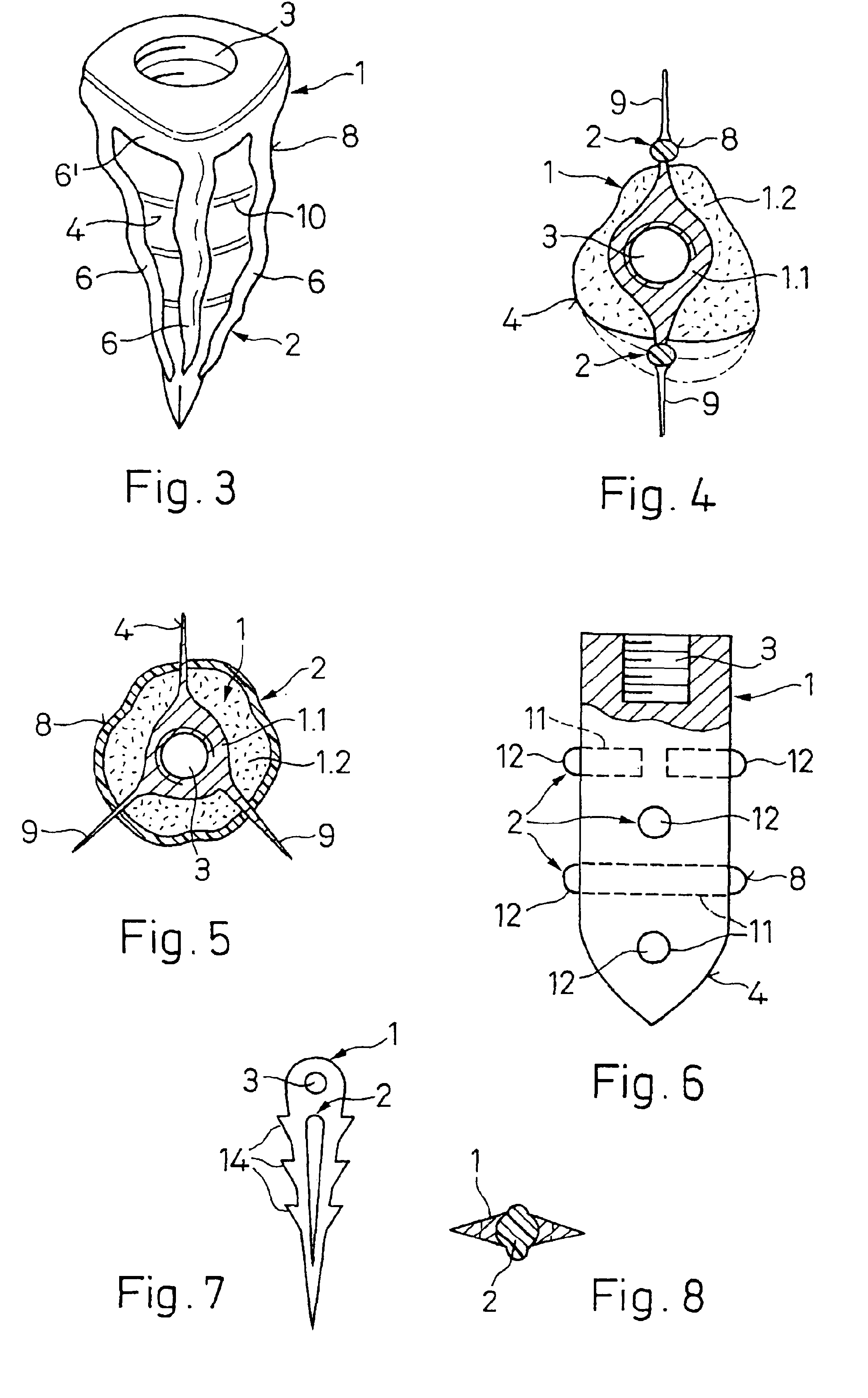 Implant to be implanted in bone tissue or in bone tissue supplemented with bone substitute material