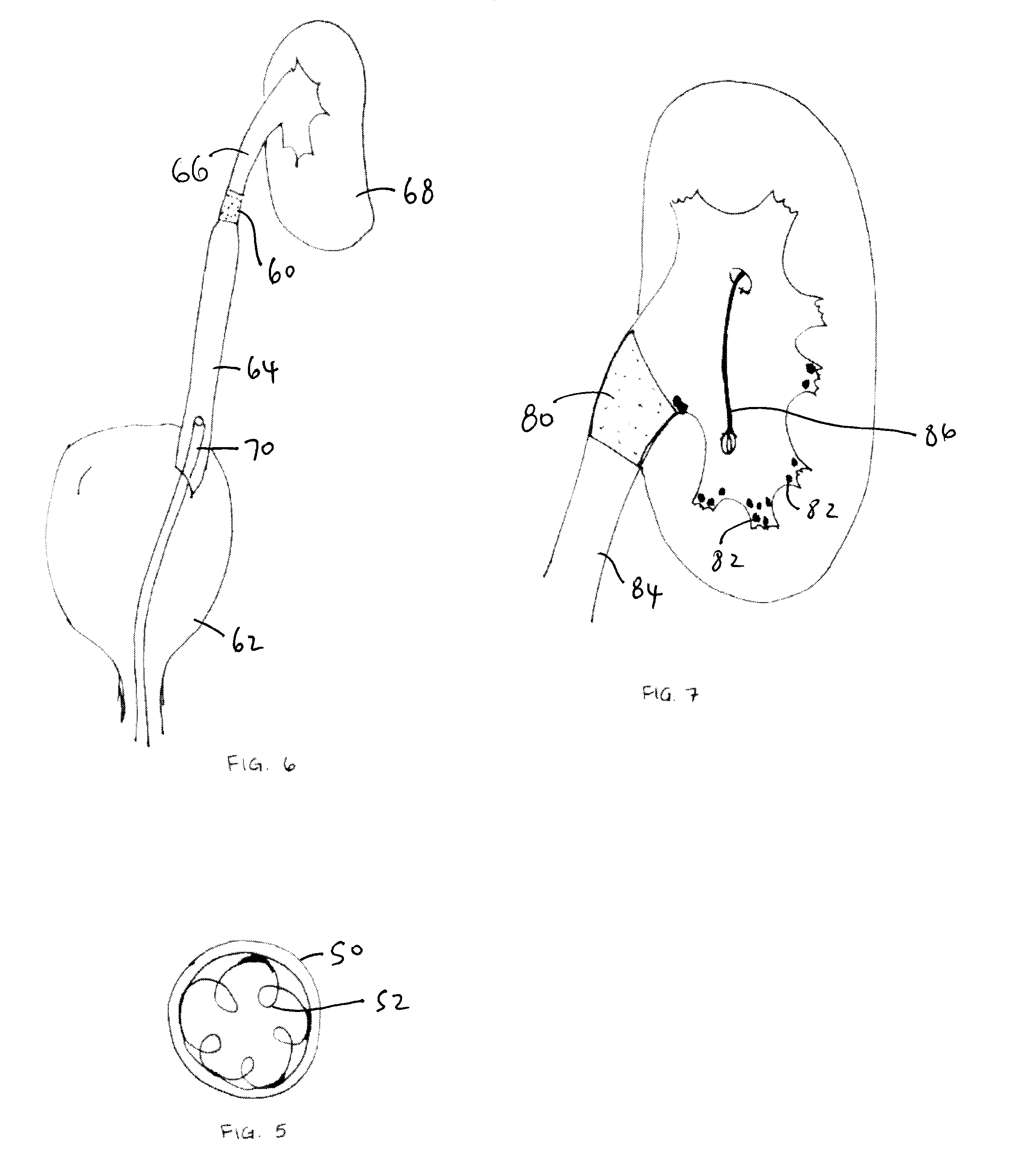 Methods and Apparatus for Temporarily Occluding Body Lumens