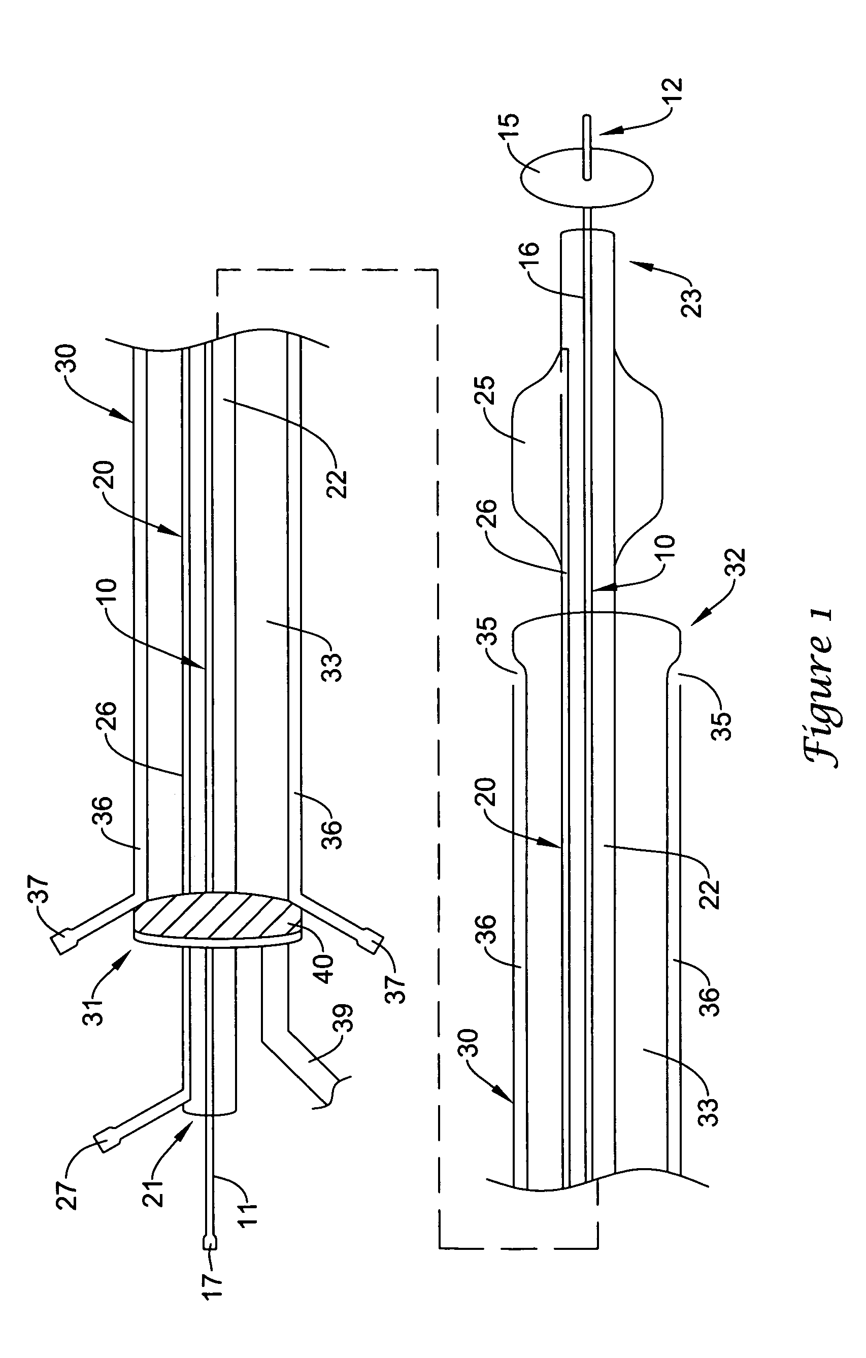 Endoluminal occlusion-irrigation catheter with aspiration capabilities and methods of use