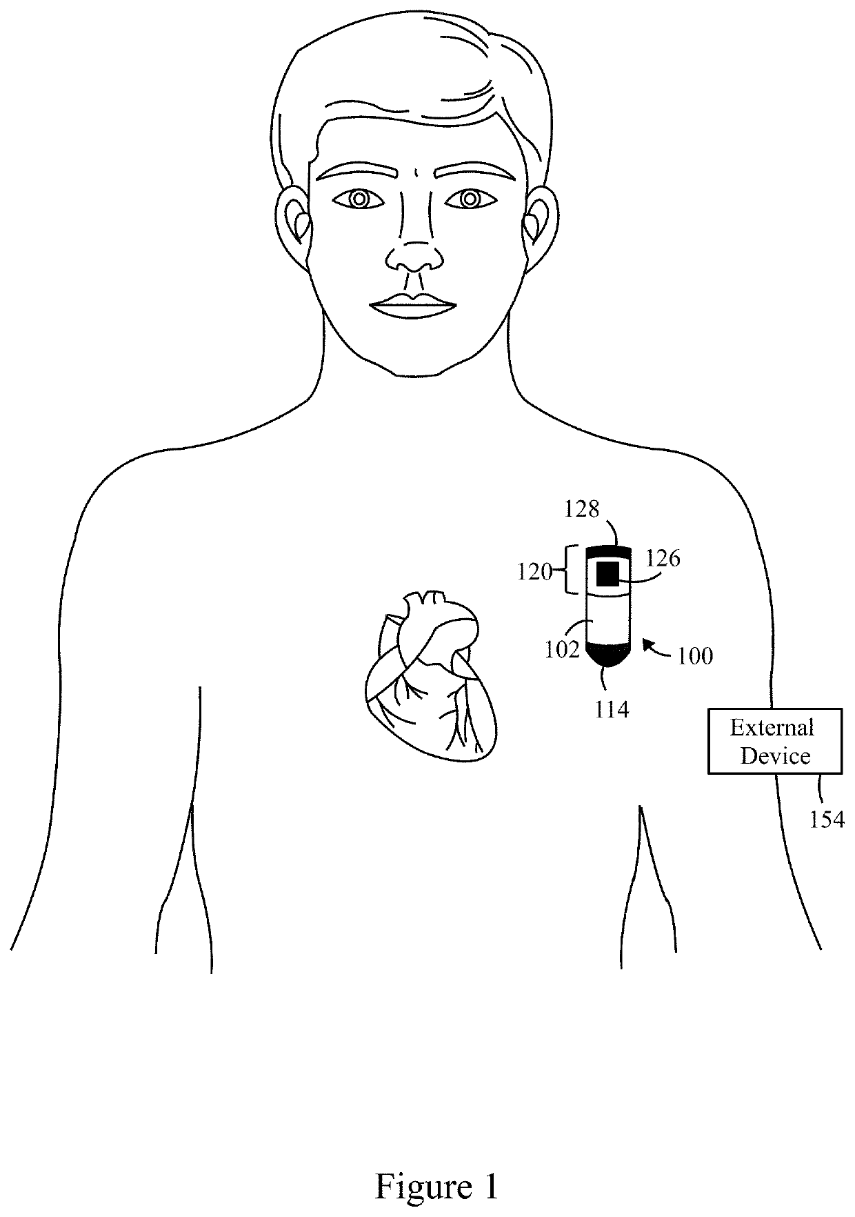 Method and system to detect R-waves in cardiac arrhythmic patterns