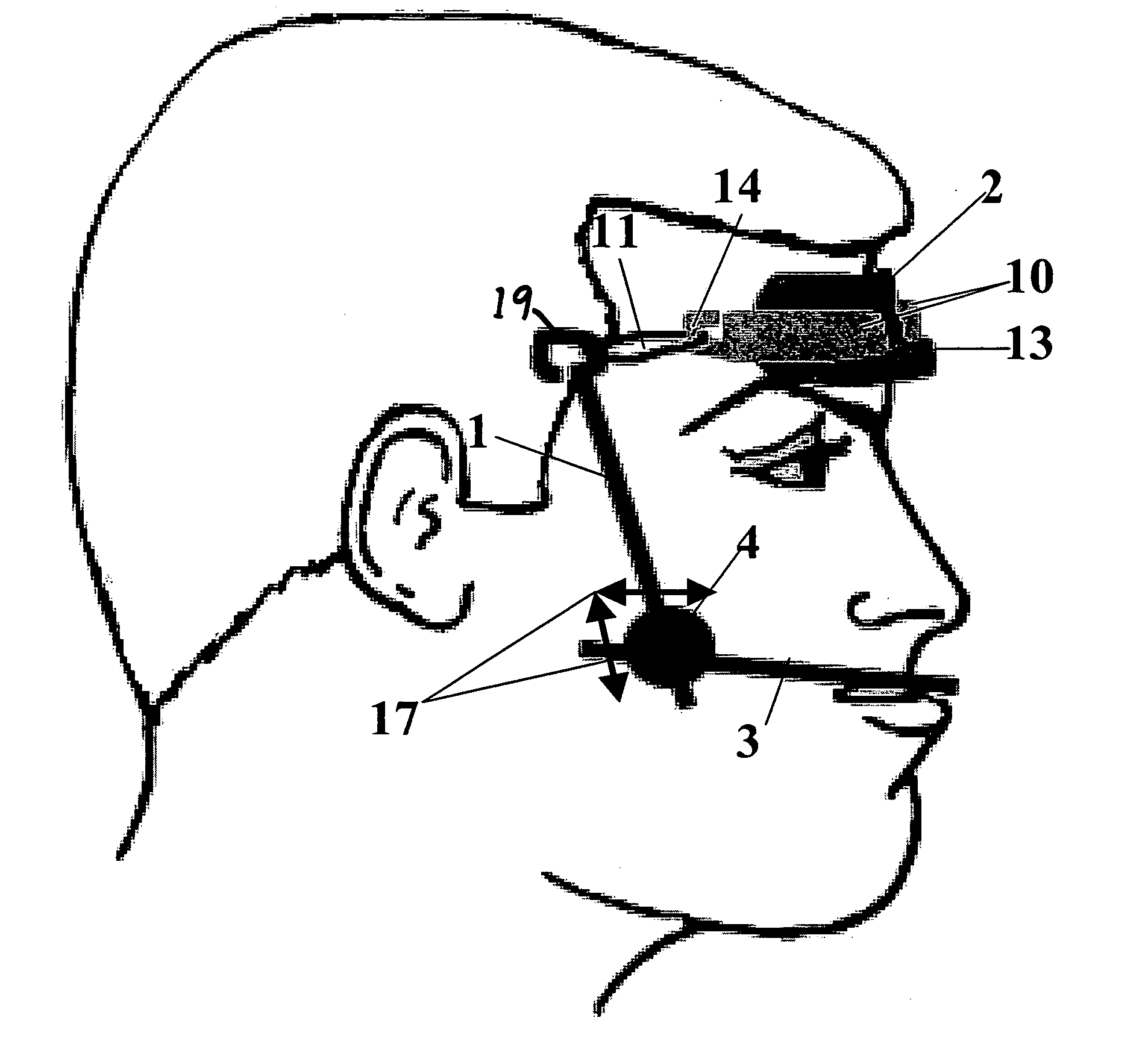 Protraction headgear