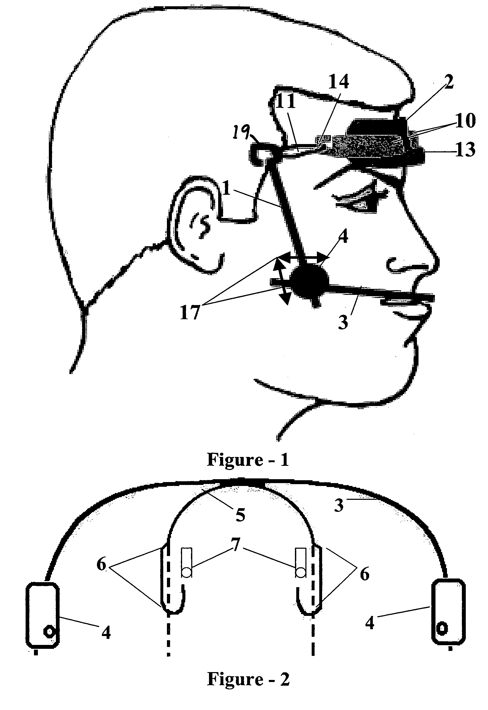 Protraction headgear