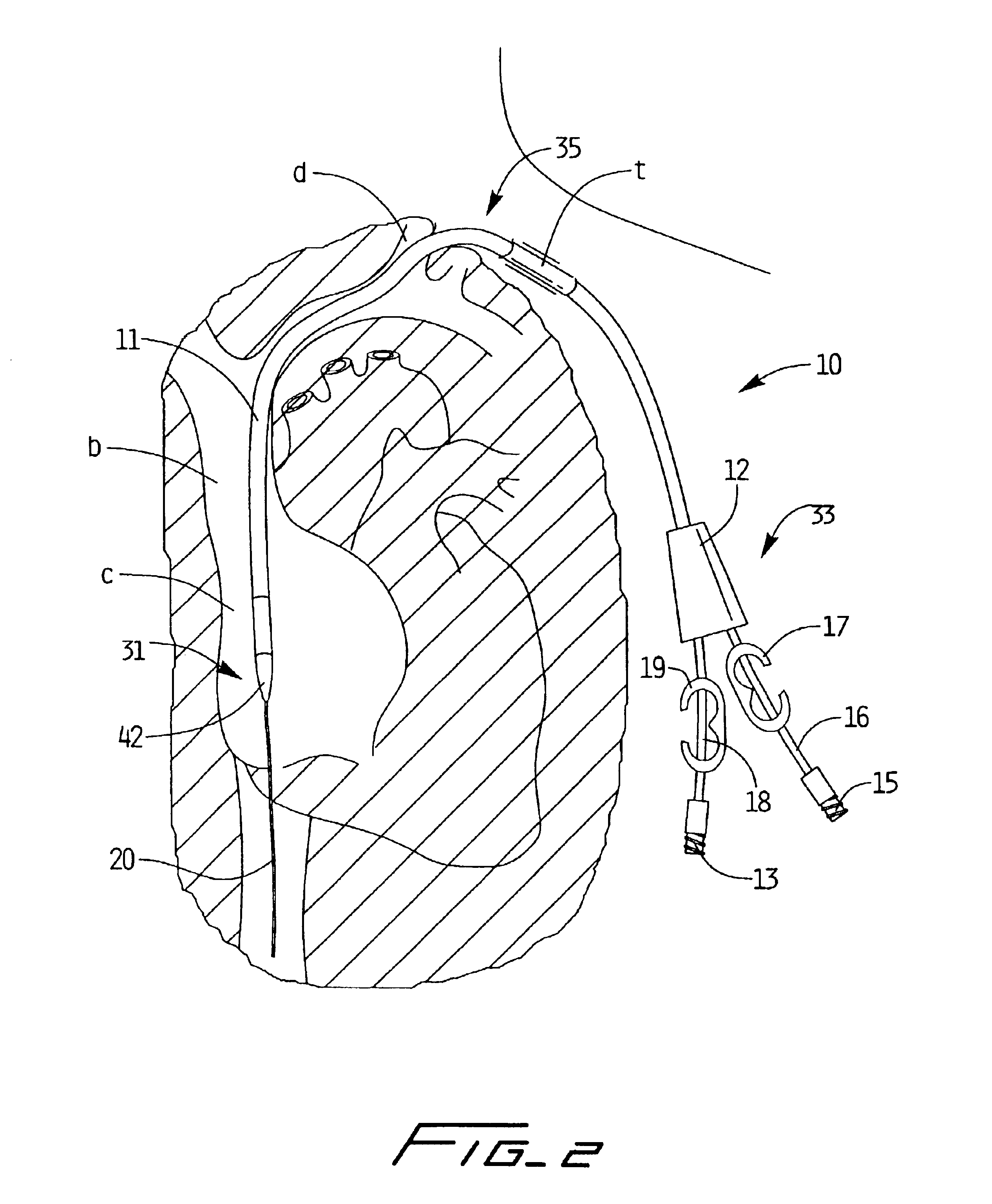 Dialysis catheter and methods of insertion