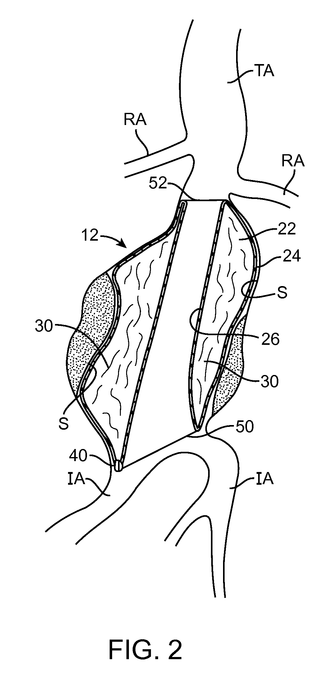 Graft systems having semi-permeable filling structures and methods for their use