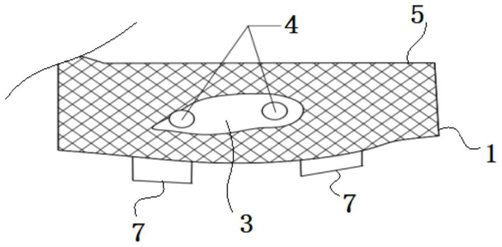 Easy-to-mount iliac wing filling block