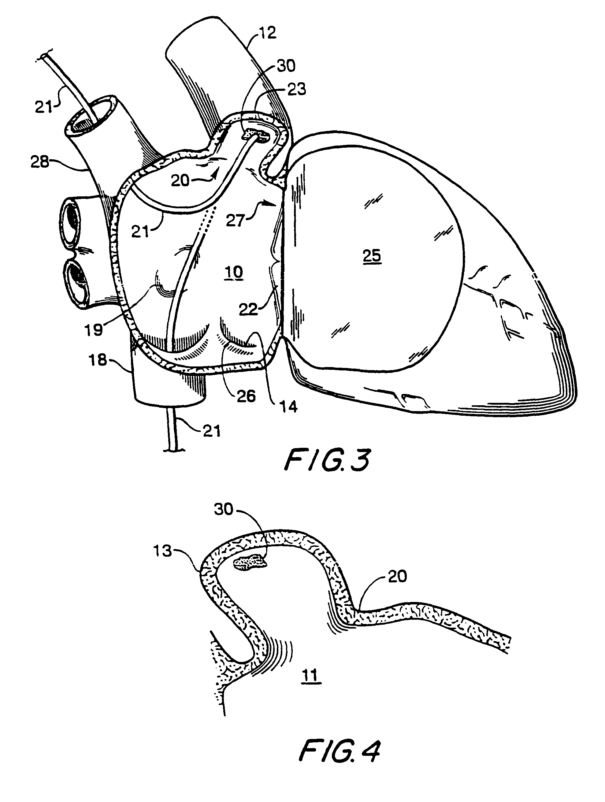 Filter apparatus for ostium of left atrial appendage