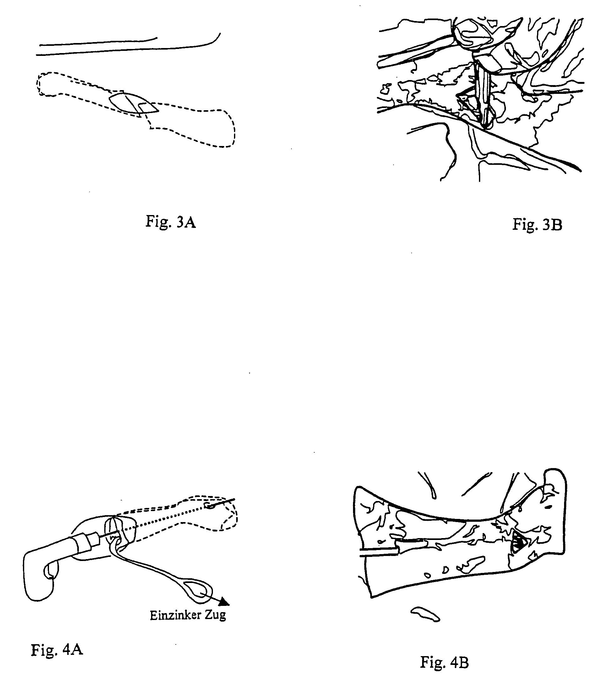 Implant for long bones and treatment method