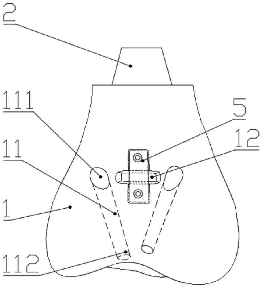 Artificial ligament bionic fixed distal femur tumor type semi-knee joint prosthesis