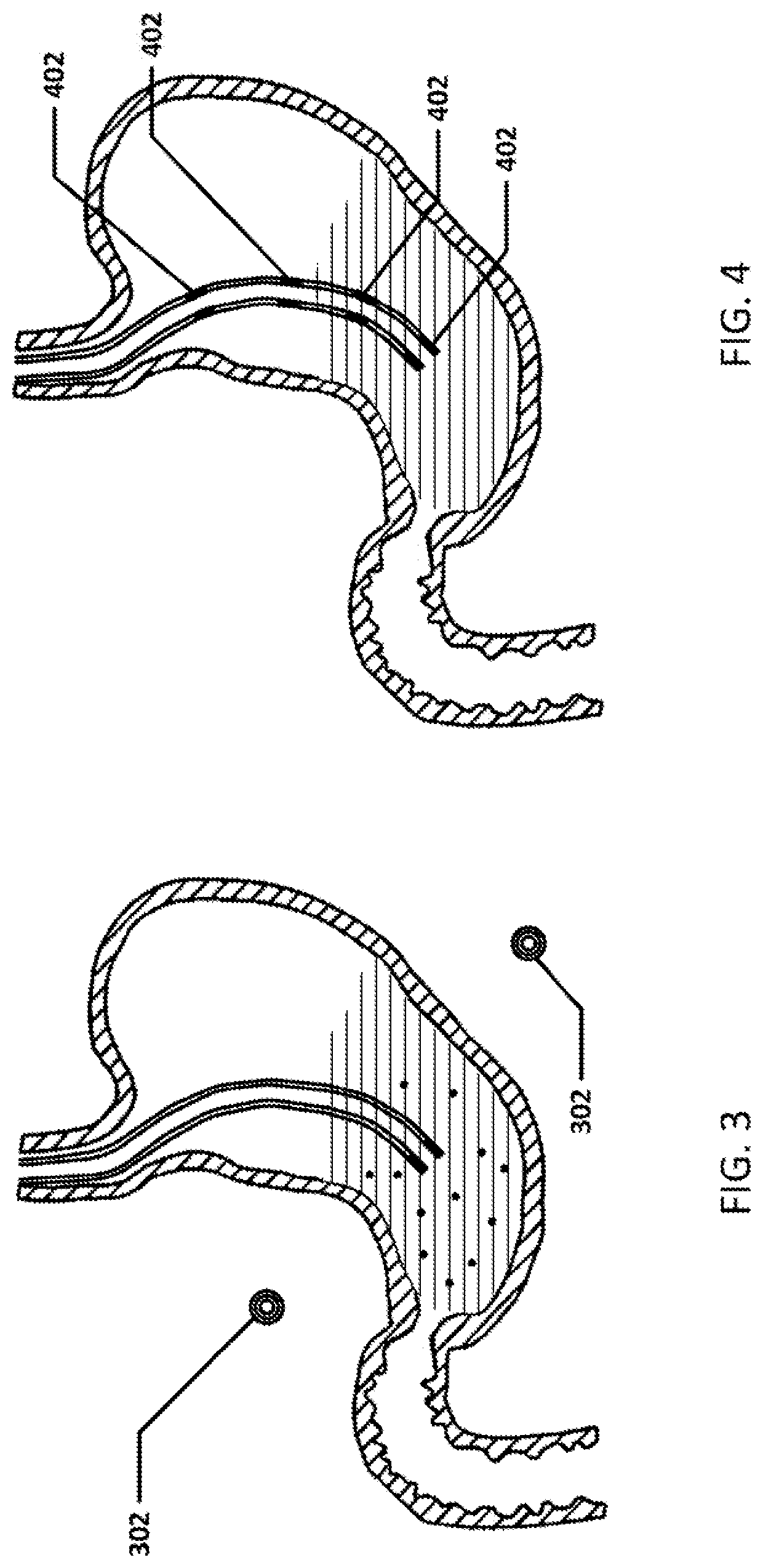 Devices and methods to measure gastric residual volume