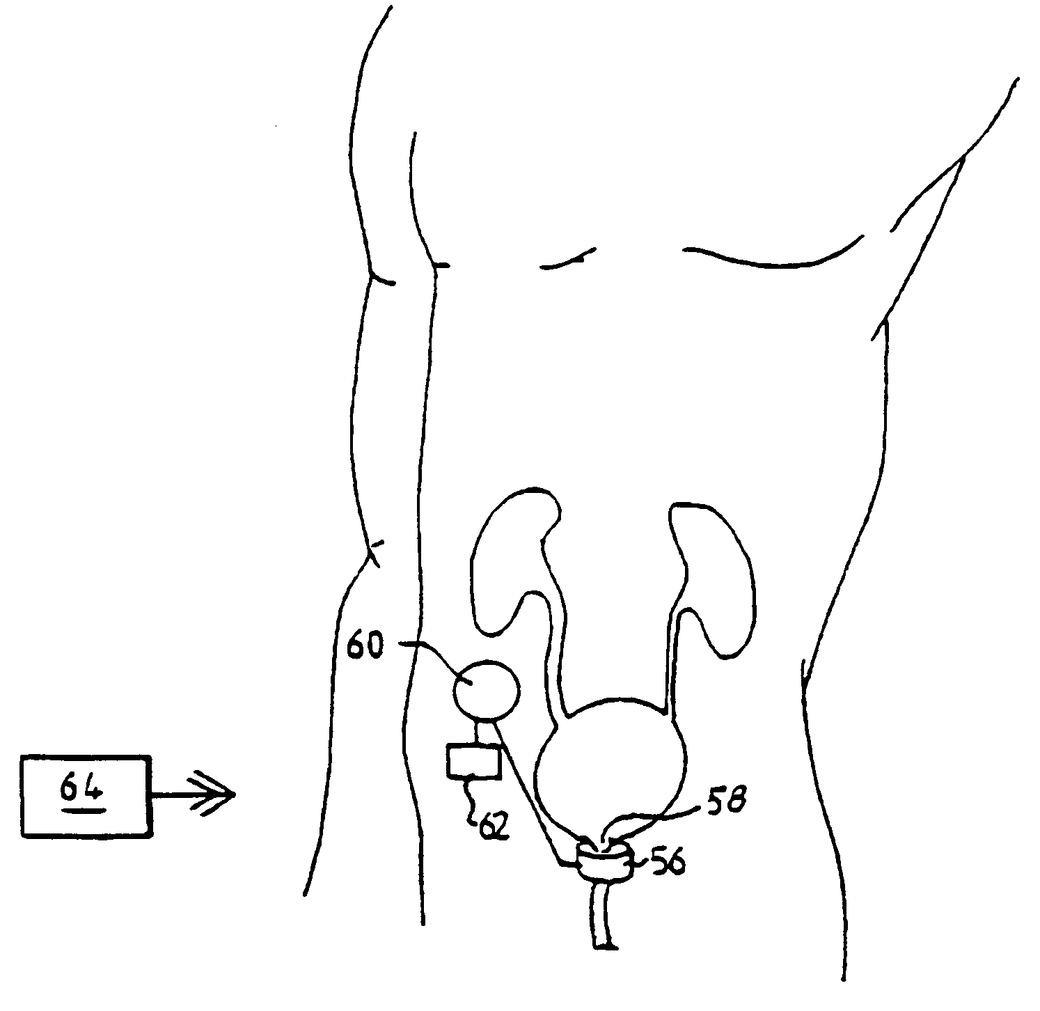 Urinary Dysfunction Treatment Apparatus