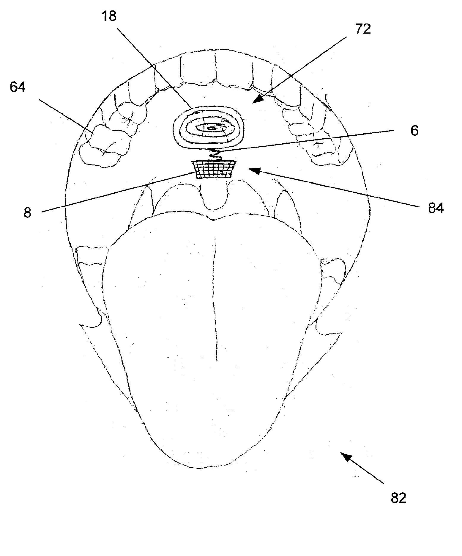 Tethered Airway Implants and Methods of Using the Same
