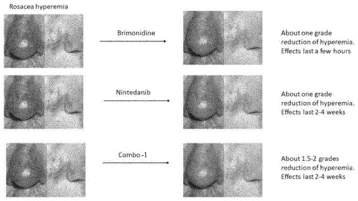 Topical composition for treating rosacea and a method for treating rosacea with the same