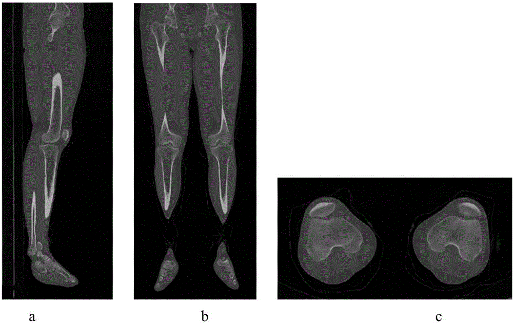 Virtual unicompartmental knee arthroplasty model construction method based on point-to-point registration technology