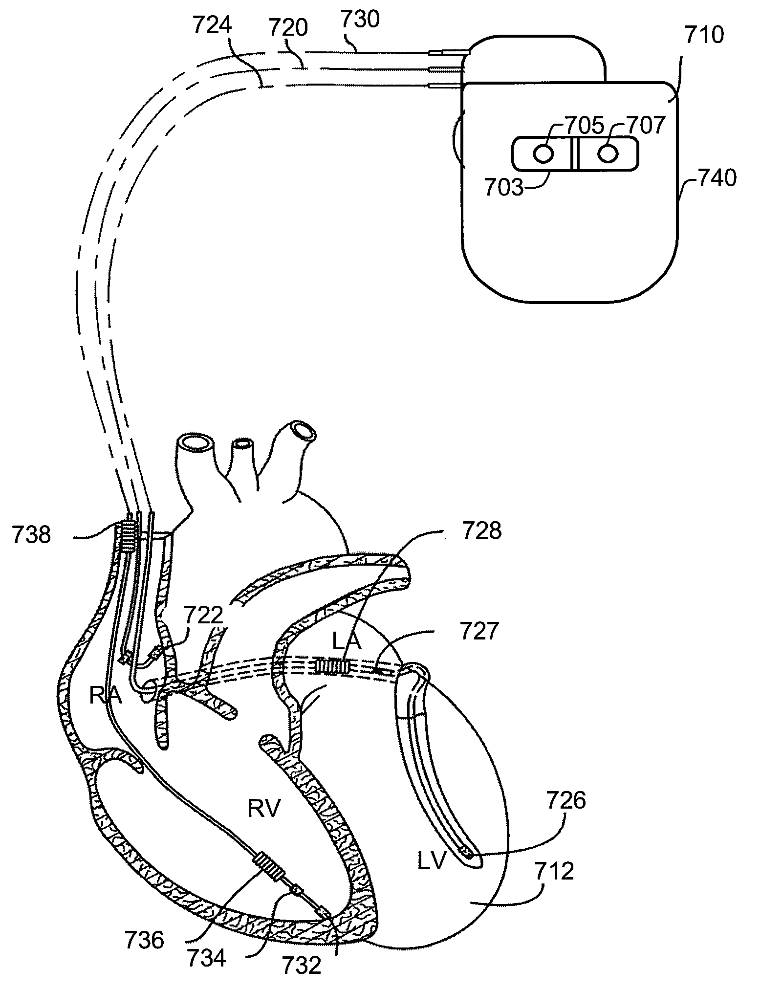 Methods and systems to monitor cardiac contractility