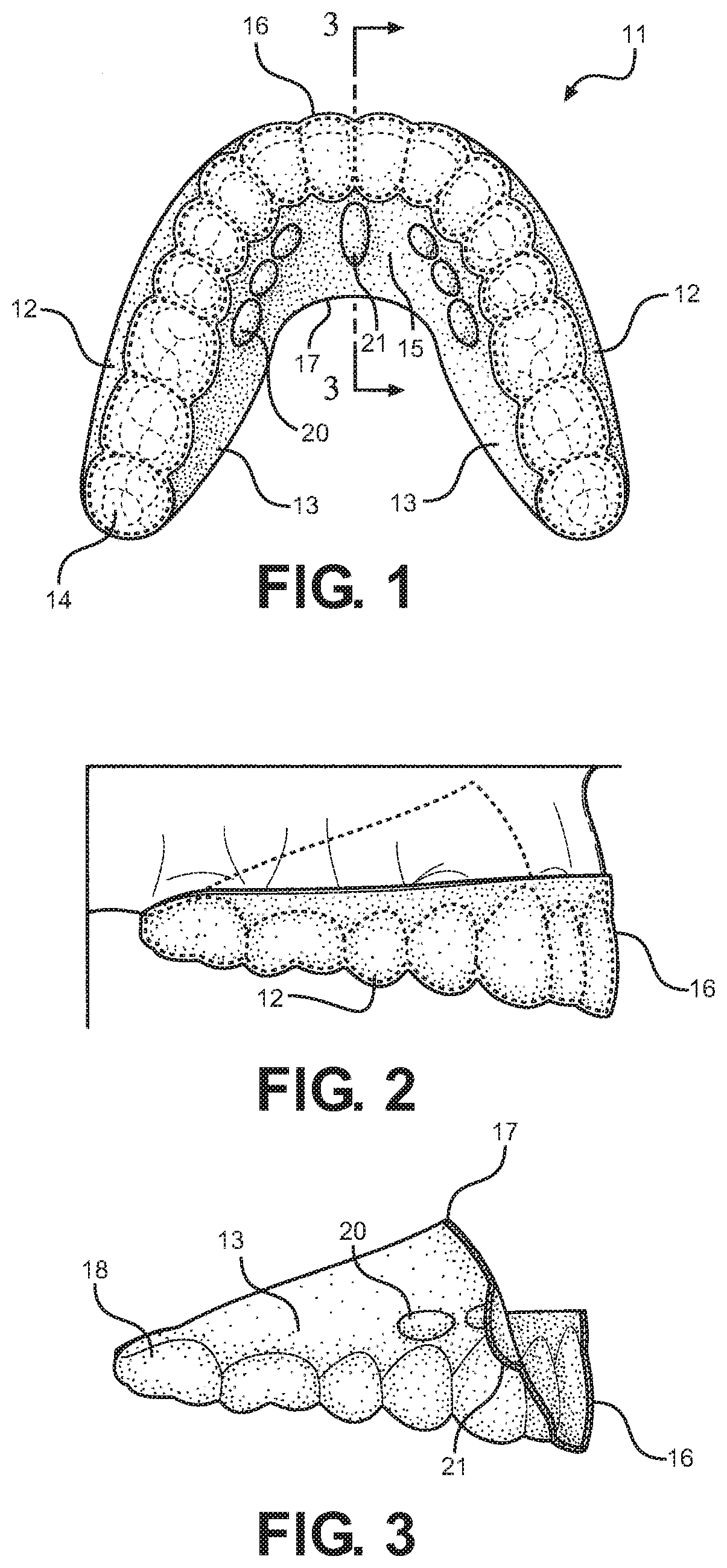 Method and oral appliance for improving air intake and reducing bruxism