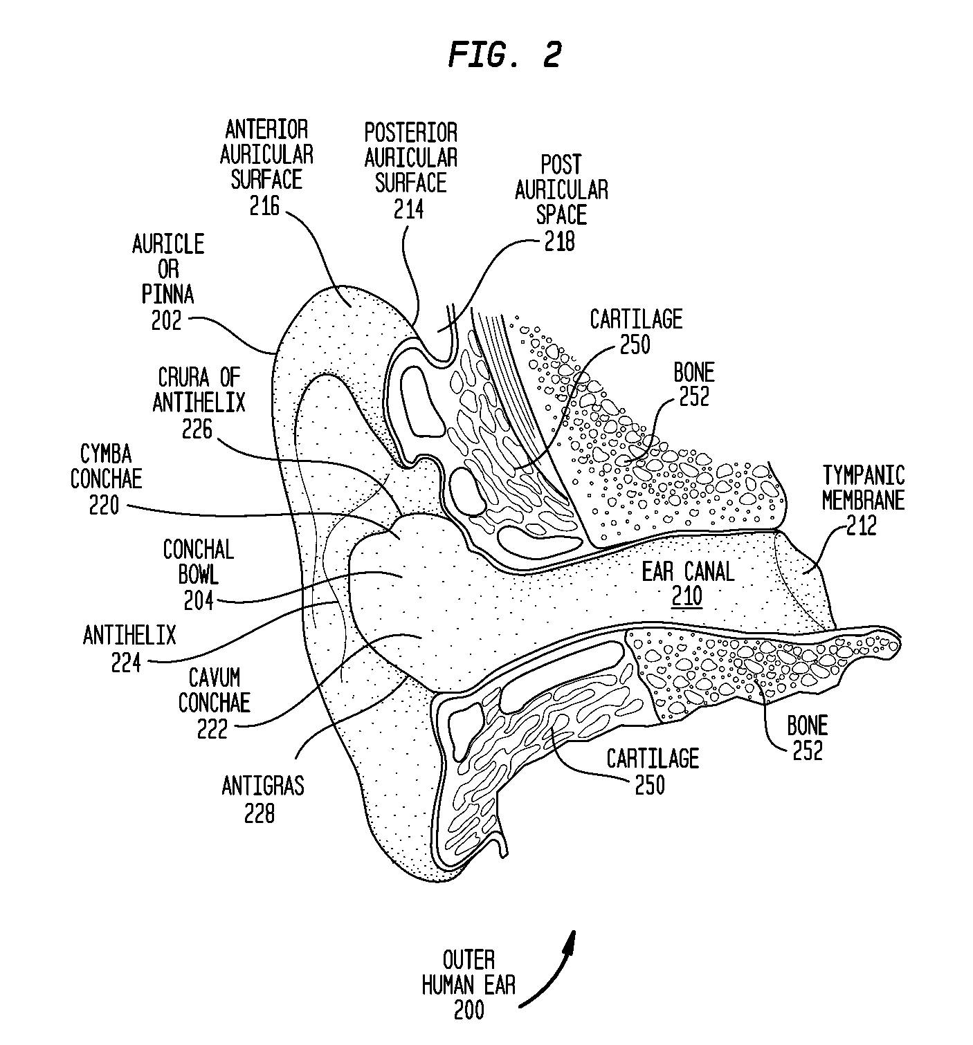 Hearing device having one or more in-the-canal vibrating extensions