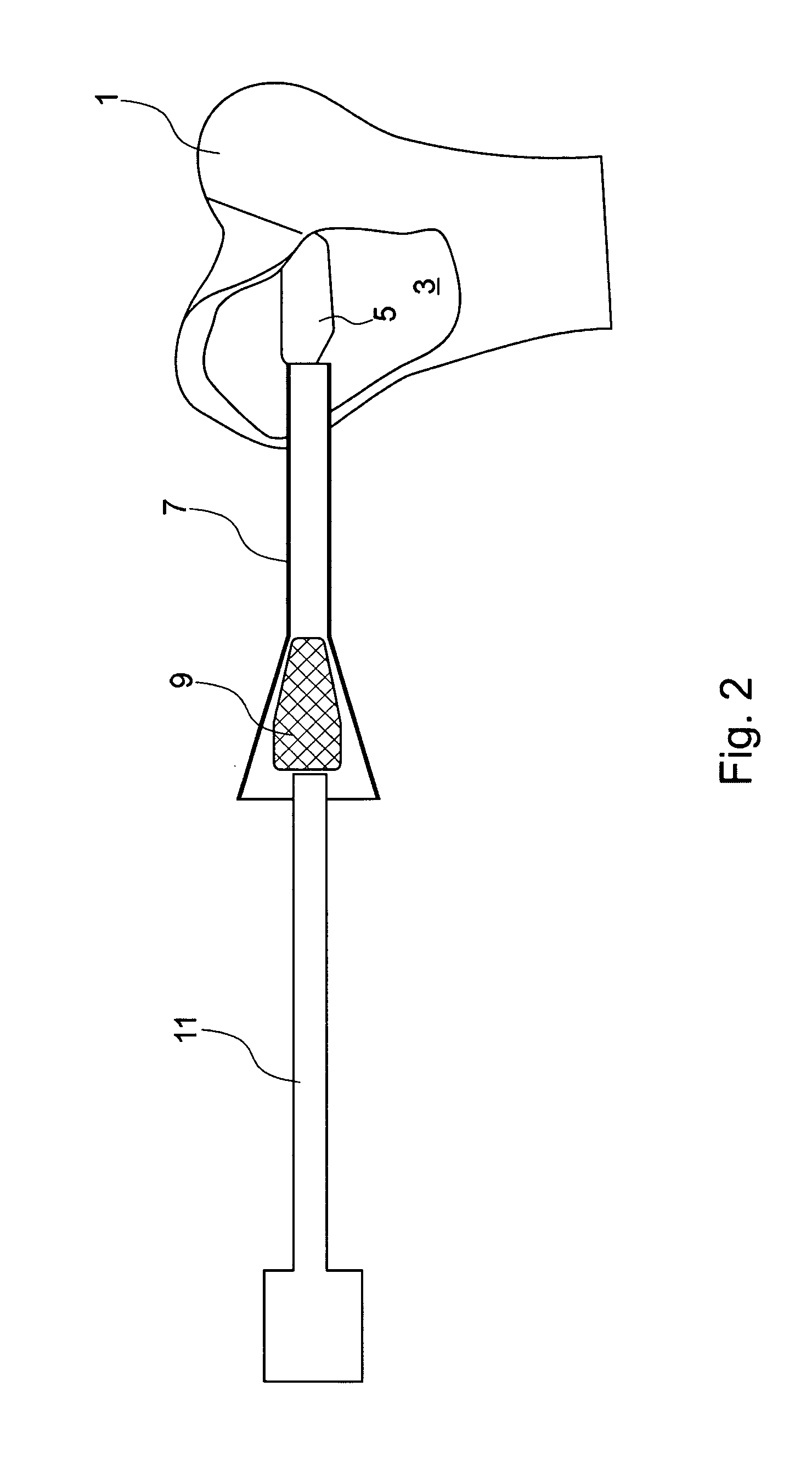 Synthetic bone substitute, method for preparing same and method for filing a cavity in a substrate